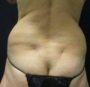 CoolSculpting Case 2 Before
