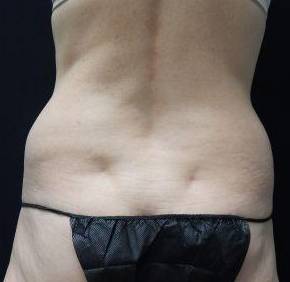 CoolSculpting Case 2 After