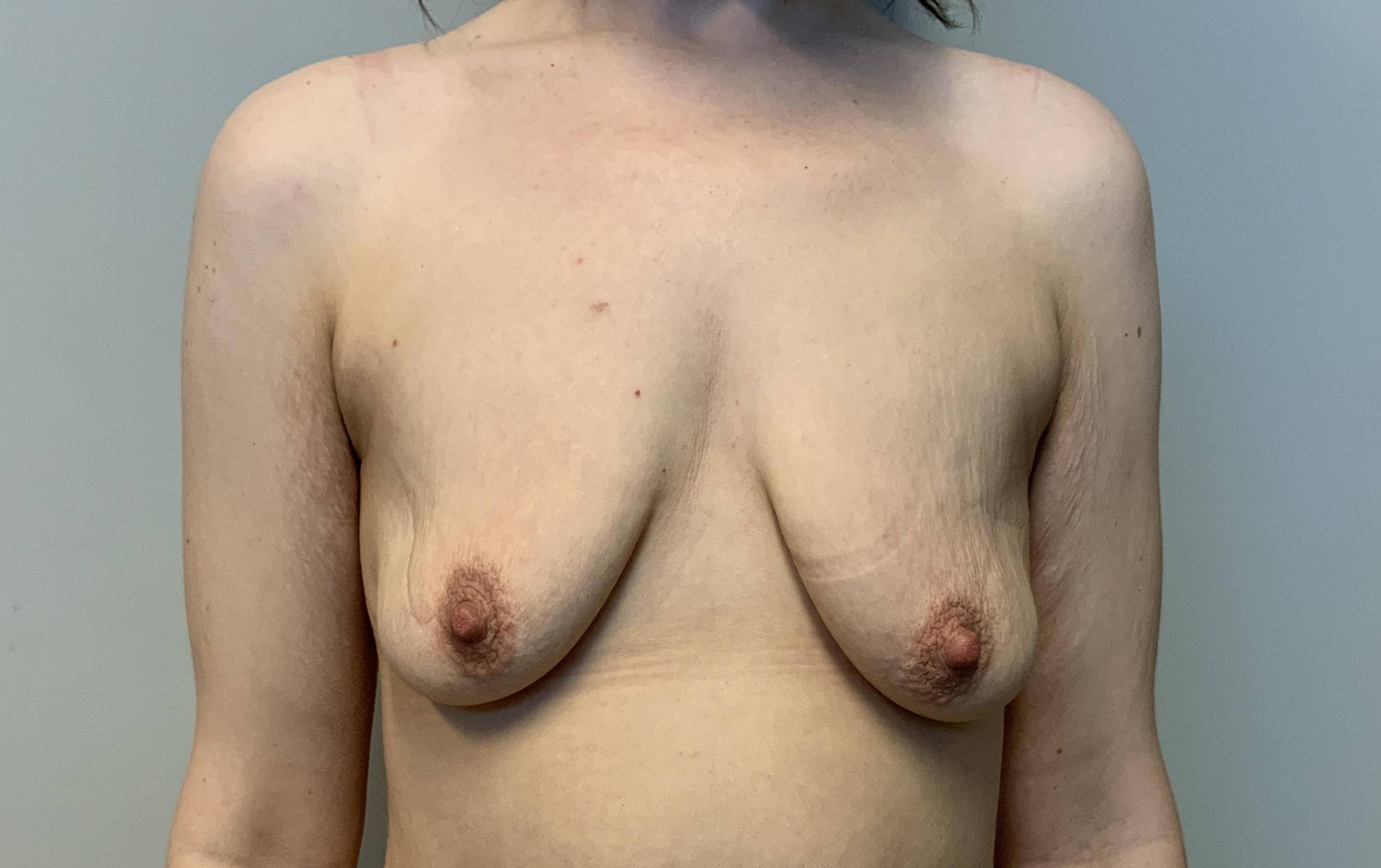 31yo Female Mastopexy w/ Augmentation Before