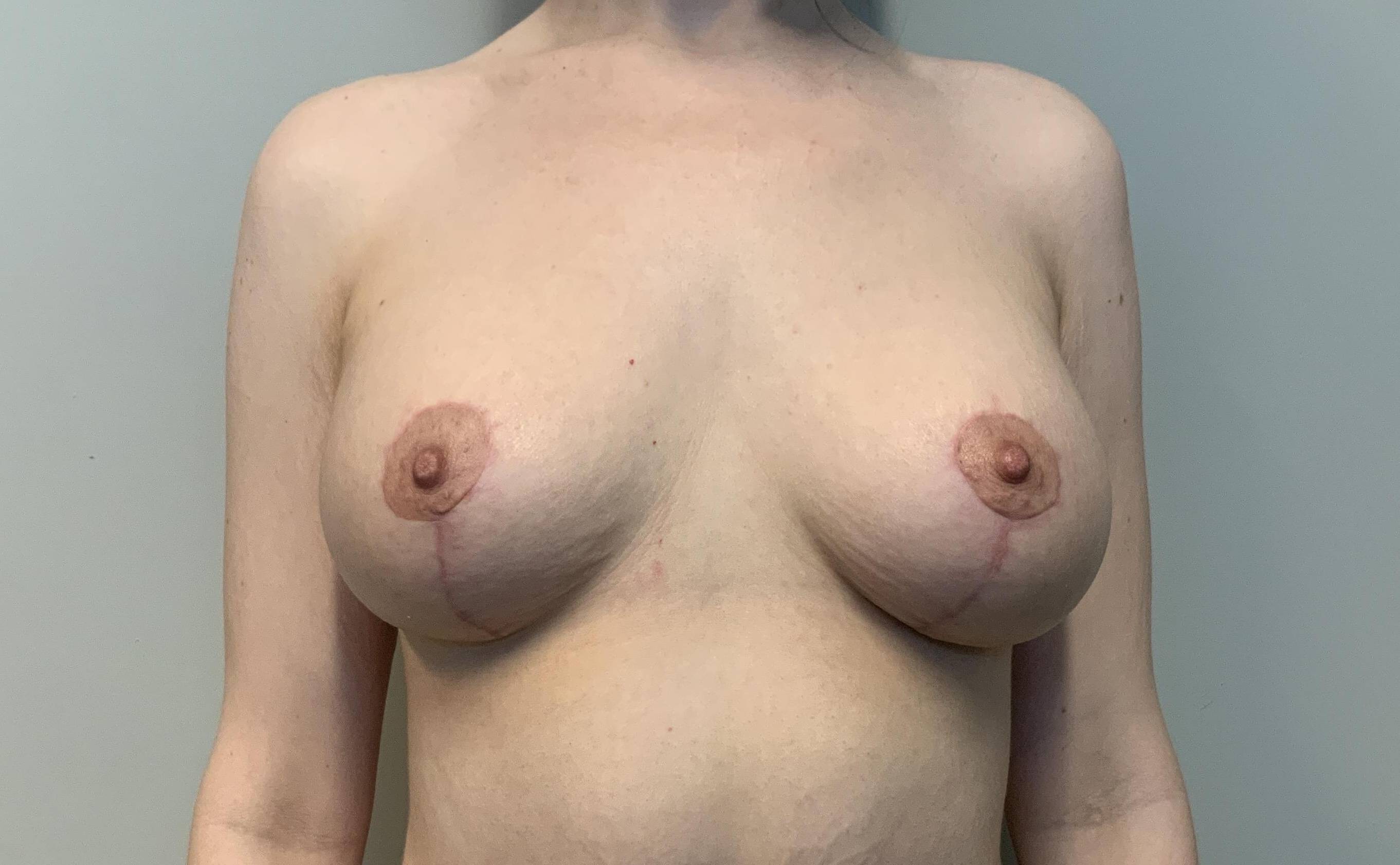 31yo Female Mastopexy w/ Augmentation After