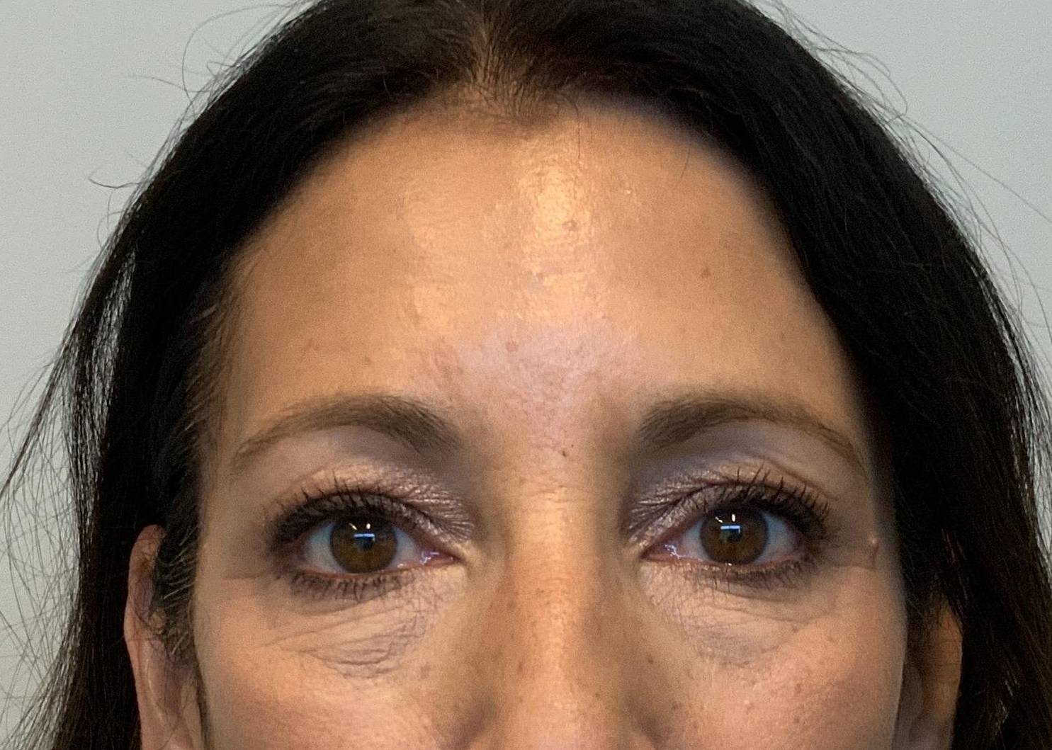 59yo female four lid Blepharoplasty Before