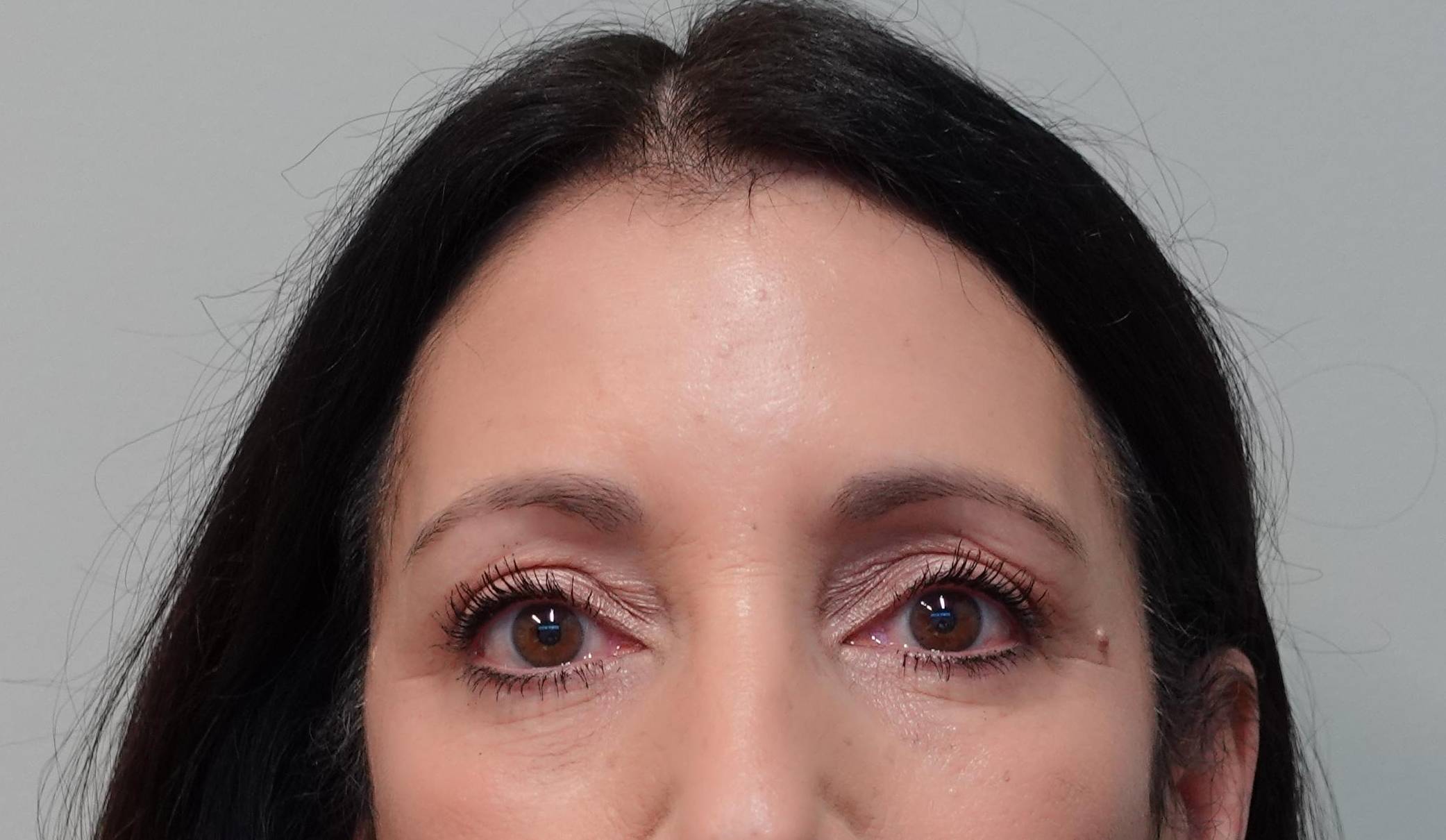 59yo female four lid Blepharoplasty After