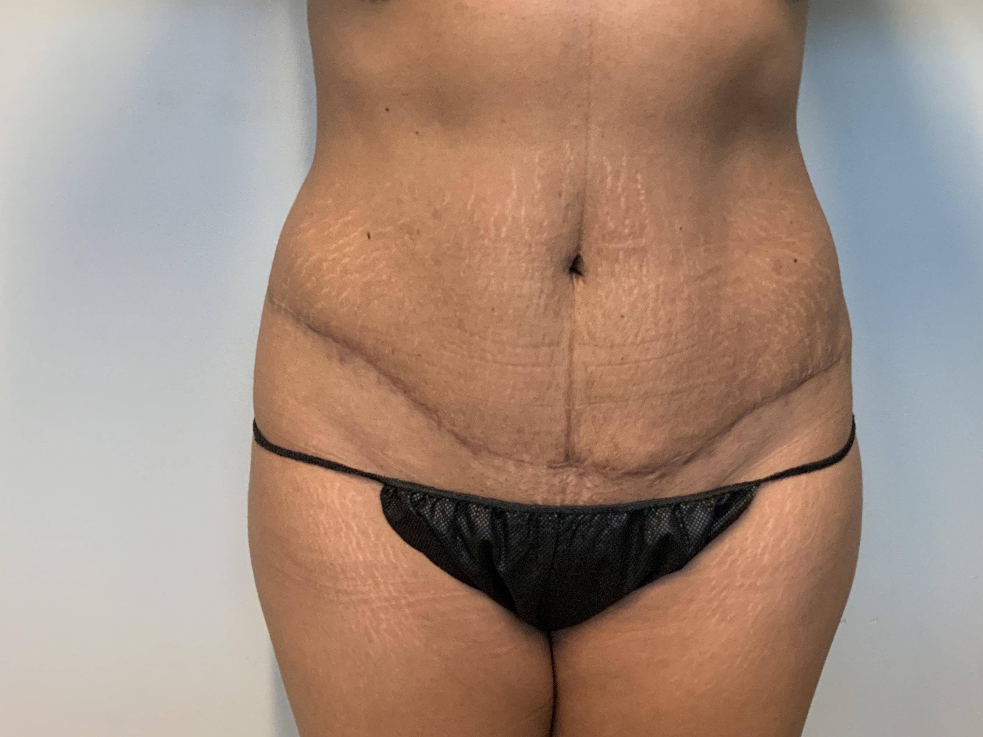 Tummy Tuck 36 year old female After