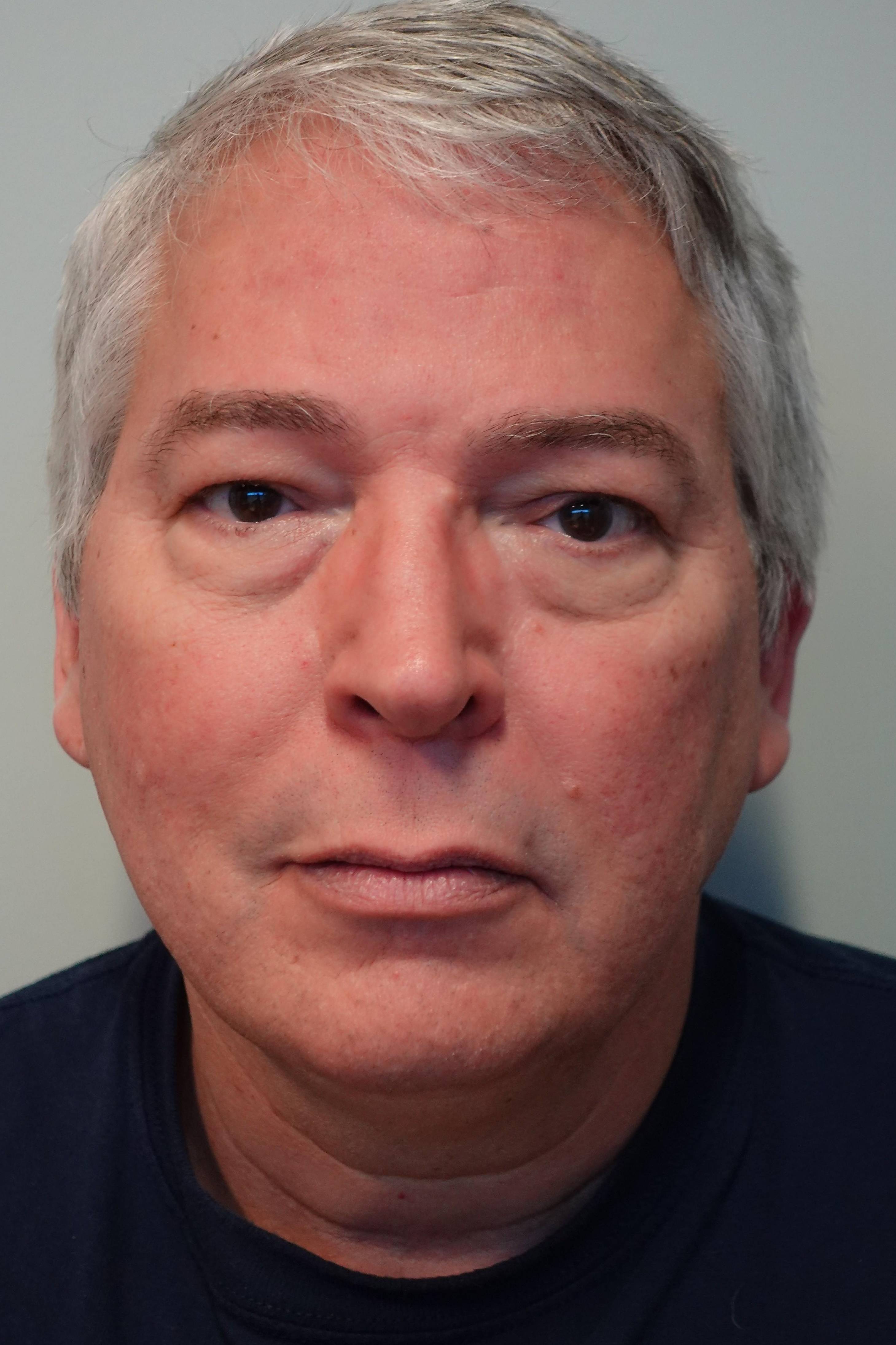 58 year old male Upper and Lower Blepharoplasty Before
