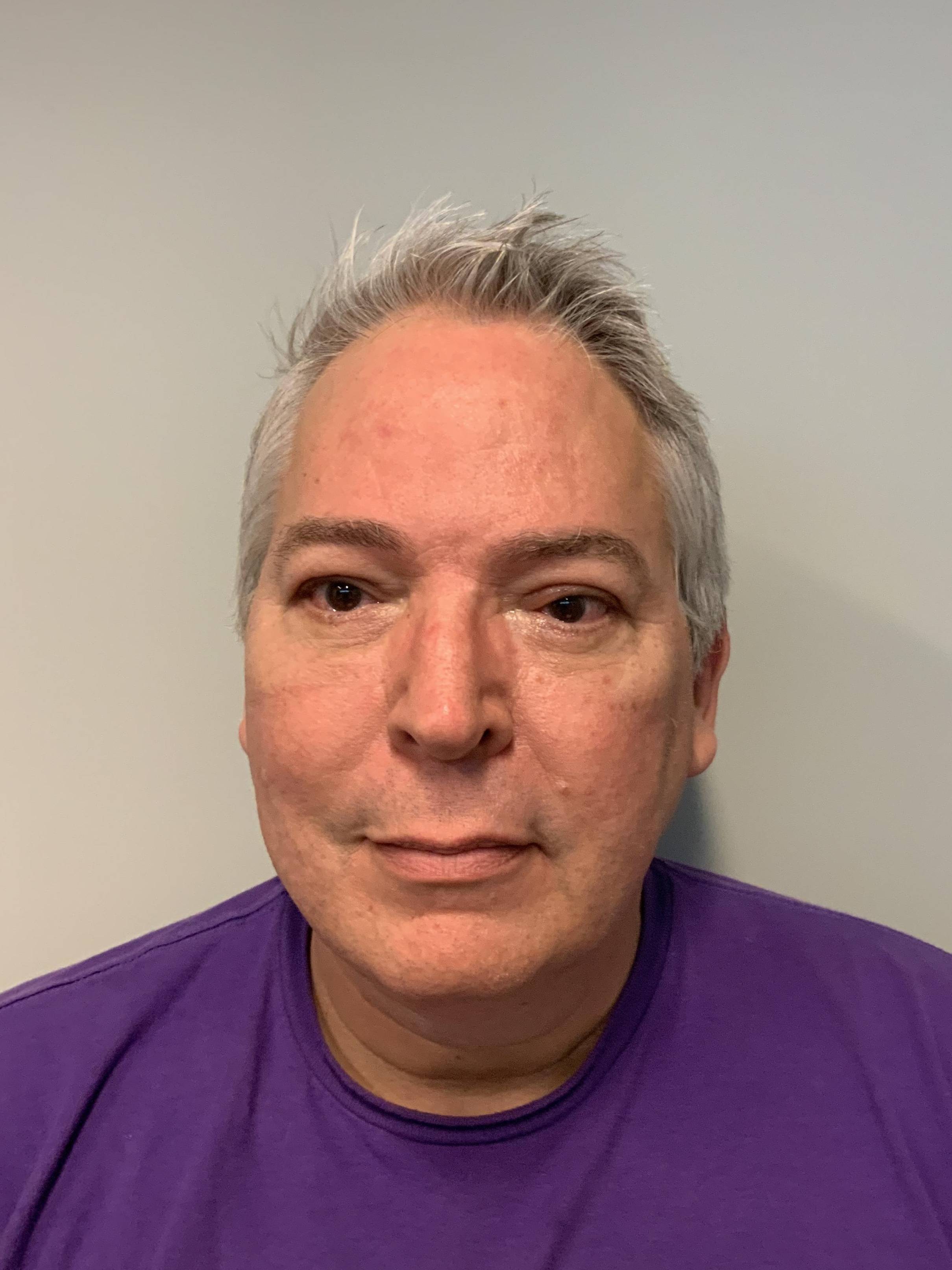 58 year old male Upper and Lower Blepharoplasty After