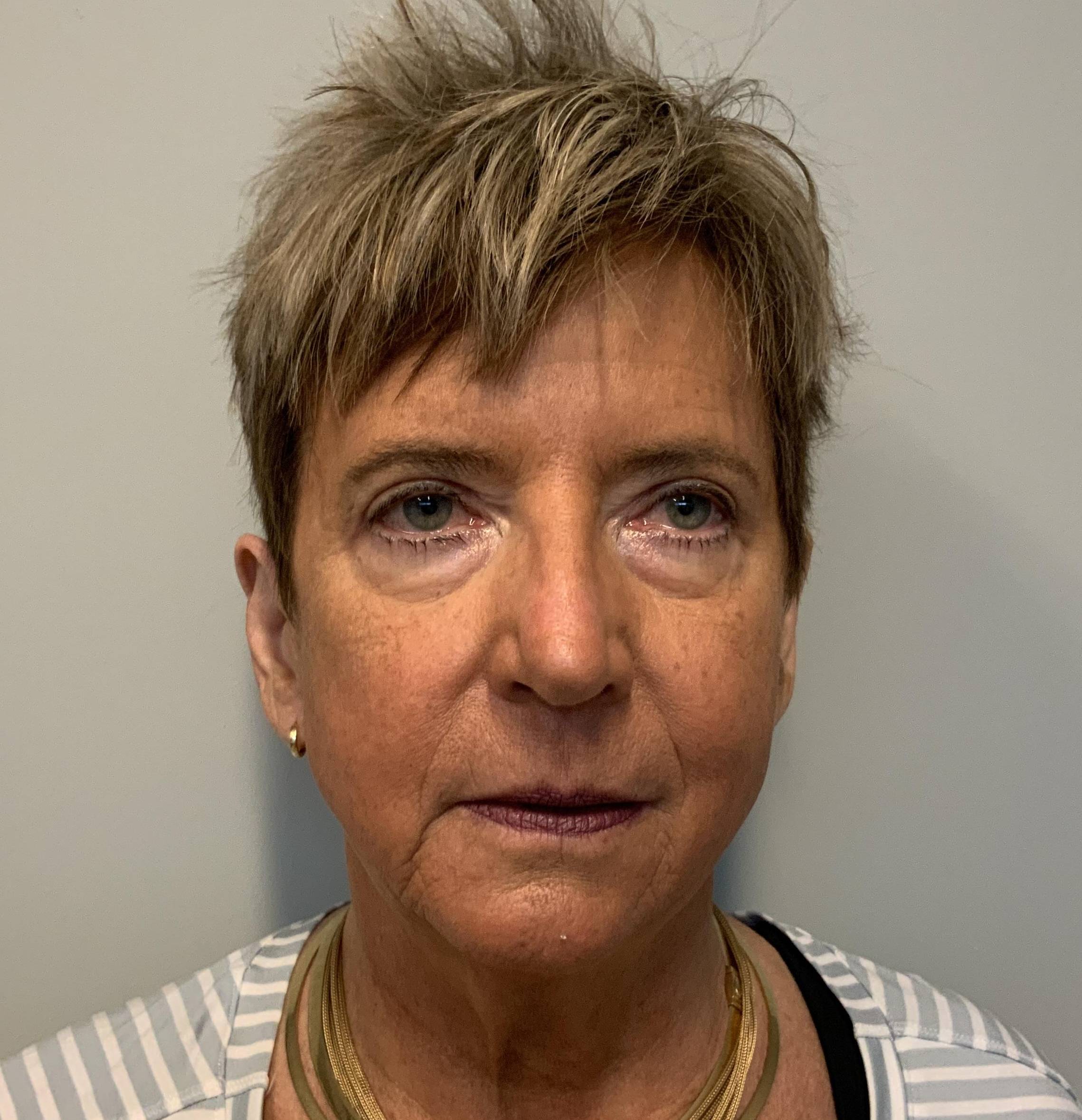 Facelift, open necklift, lower blepharoplasty Before