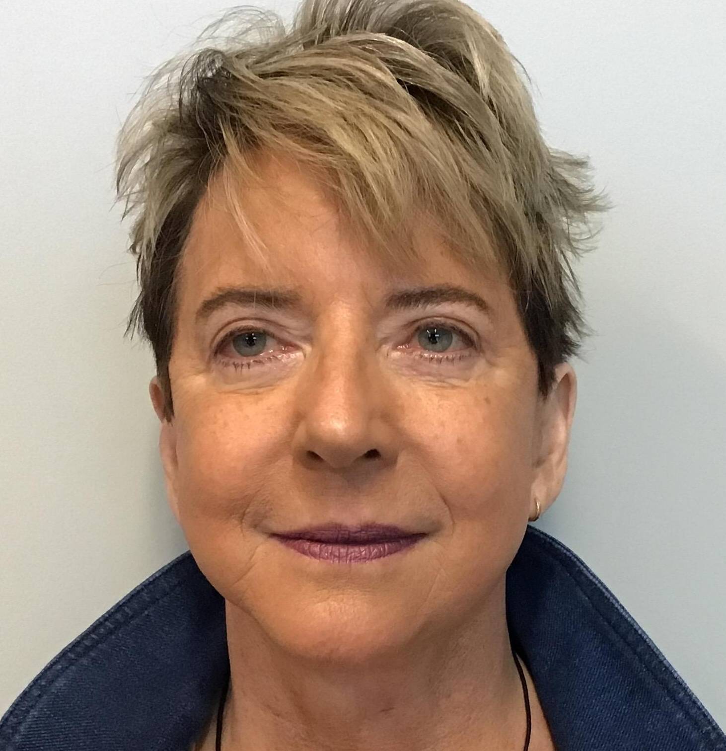 Facelift, open necklift, lower blepharoplasty After