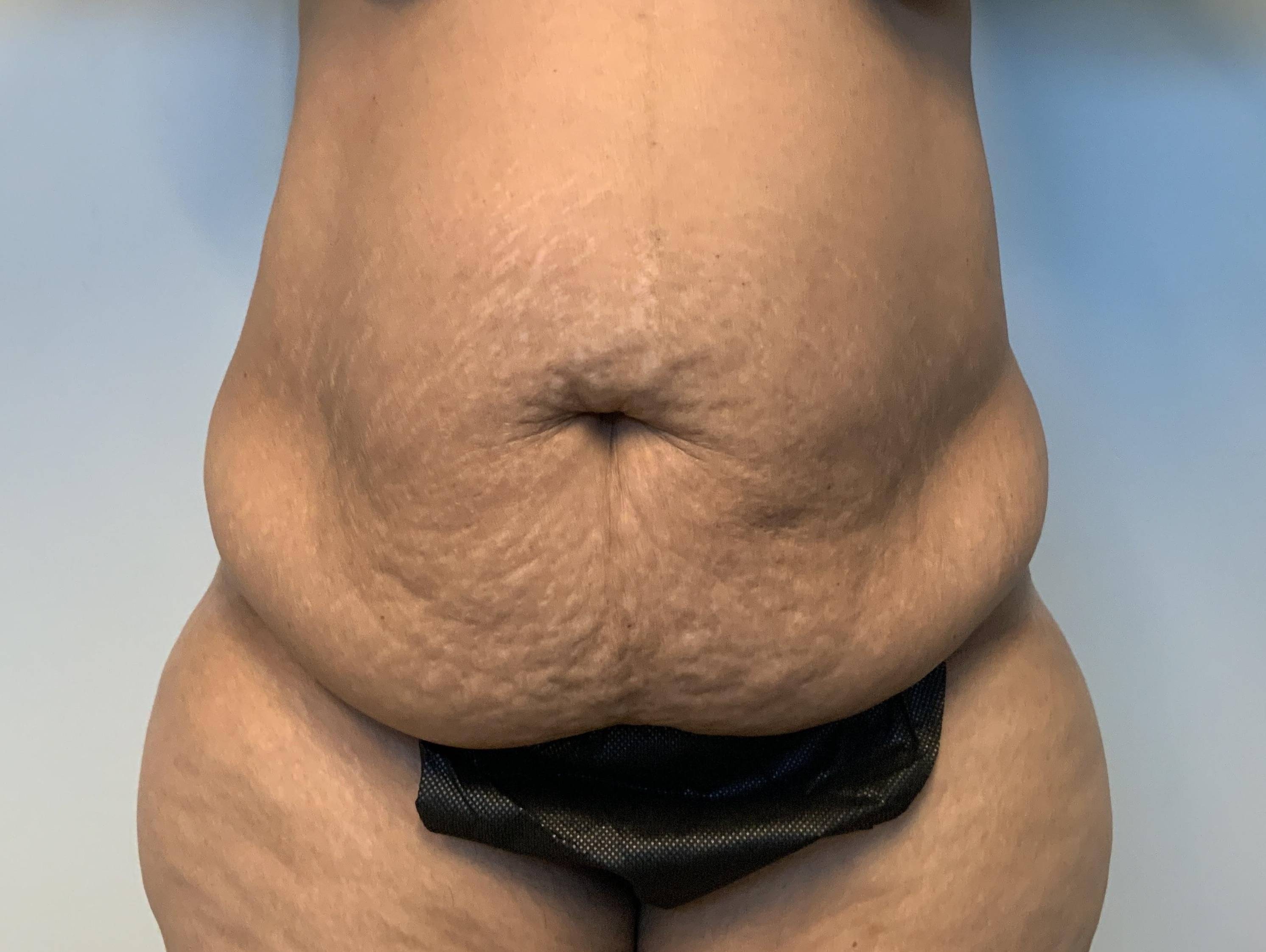 49 year old female, abdominoplasty Before