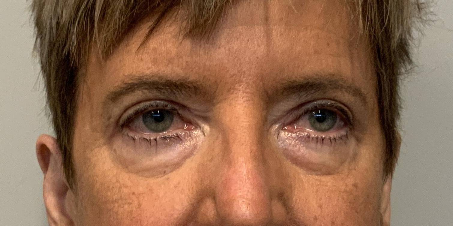 66 year old female, lower blepharoplasty Before