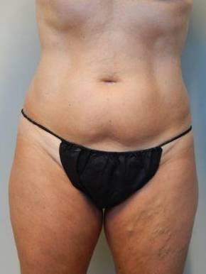 CoolSculpting Case 1 After