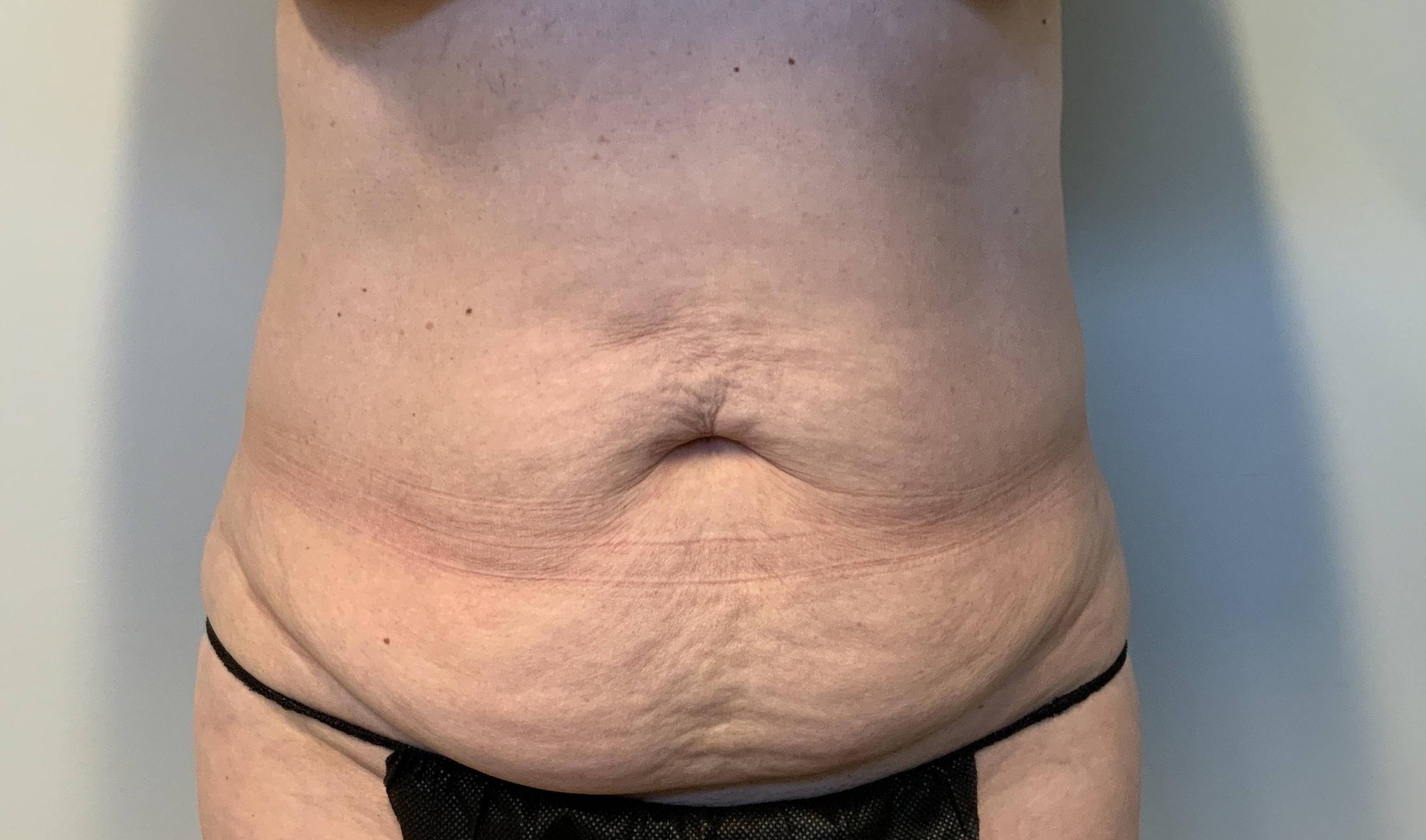 50 year old female, abdominoplasty Before