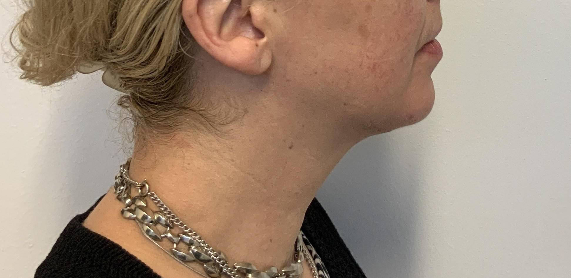 52 year old female, deep necklift After