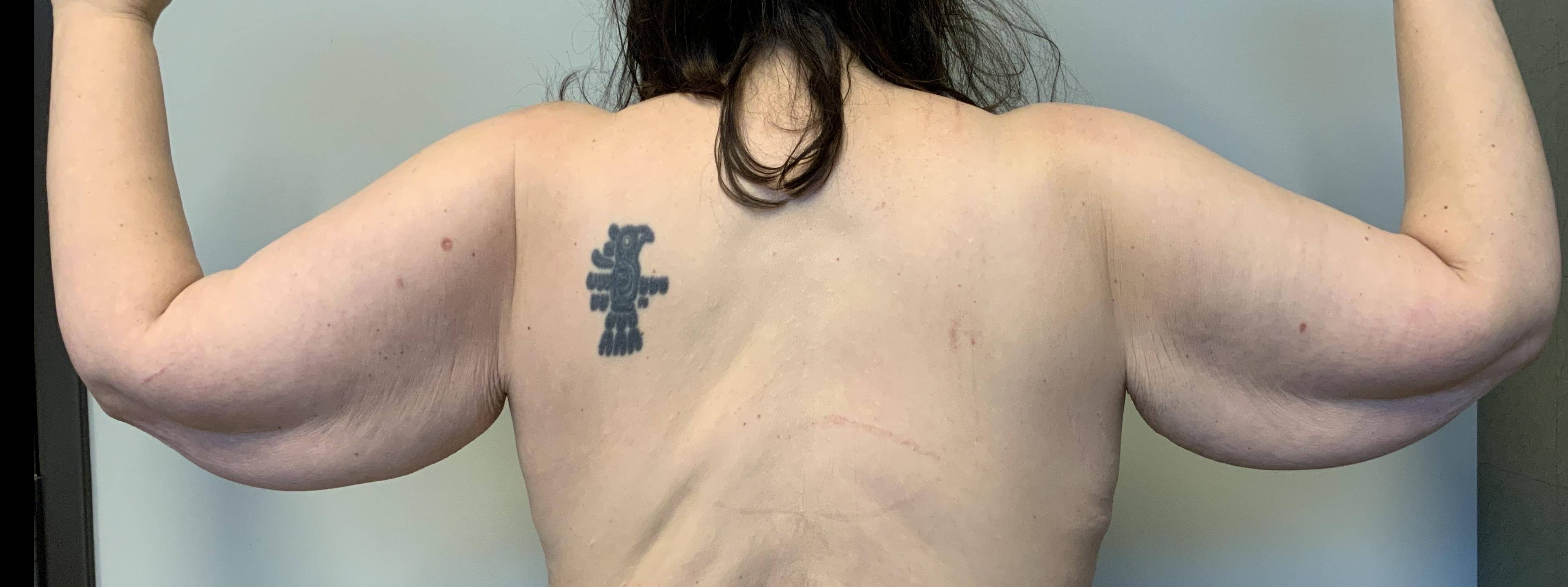 46 year old female, brachioplasty Before