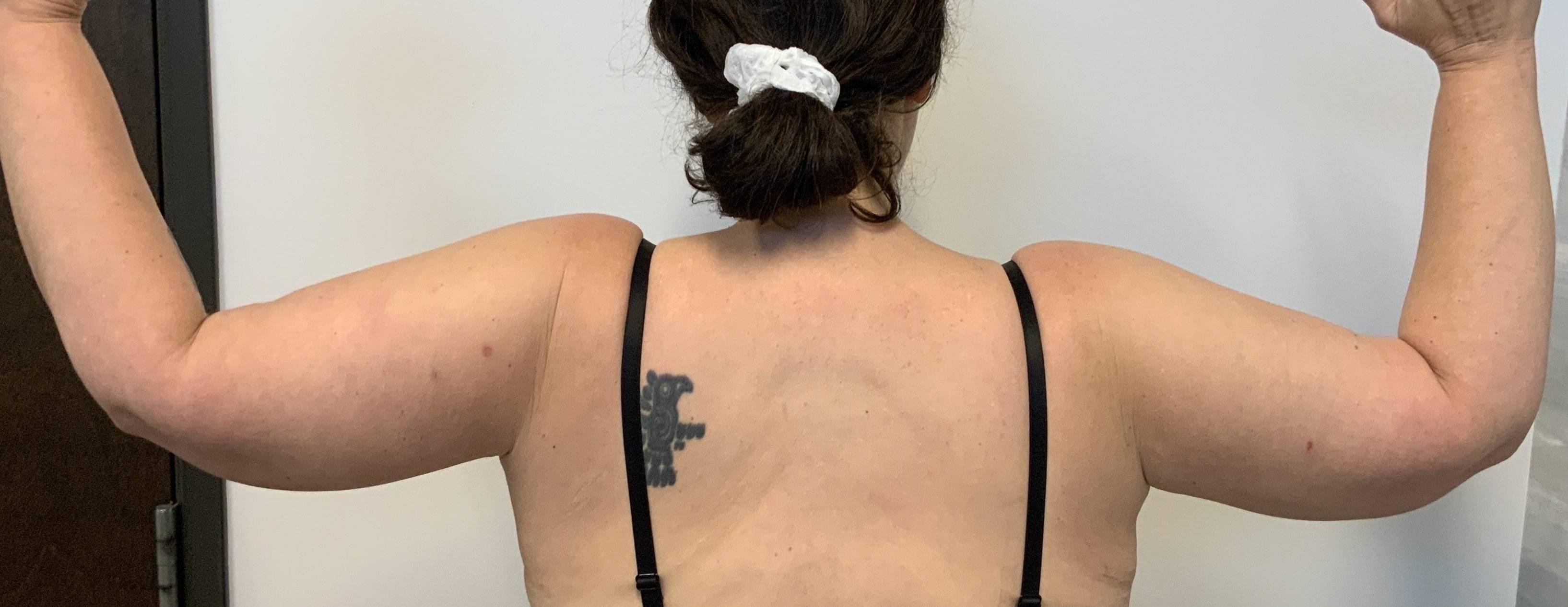 46 year old female, brachioplasty After