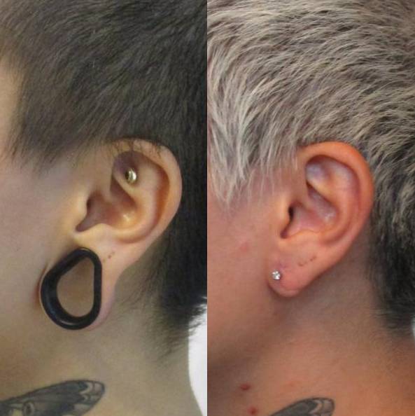Earlobe Repair Case 1 