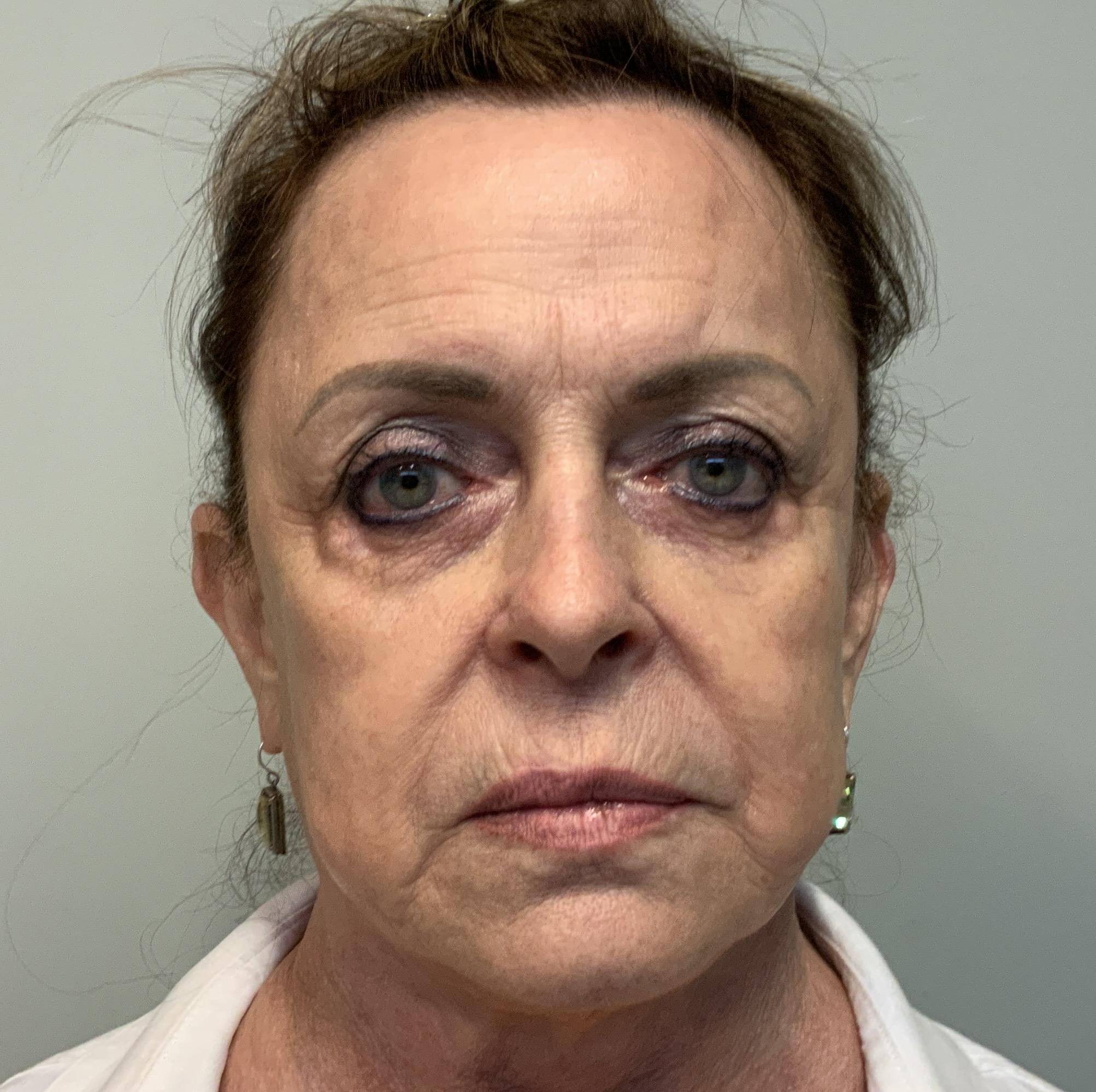 72-year-old female, facelift, lower blepharoplasty, lateral temporalplasty Before