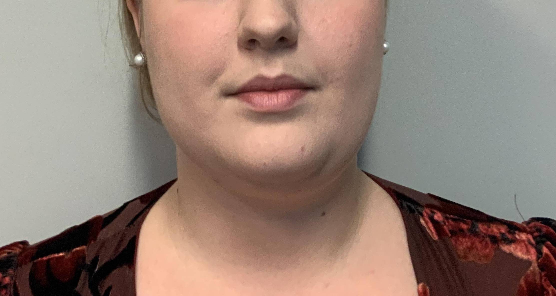 25-year-old female, submental liposuction Before