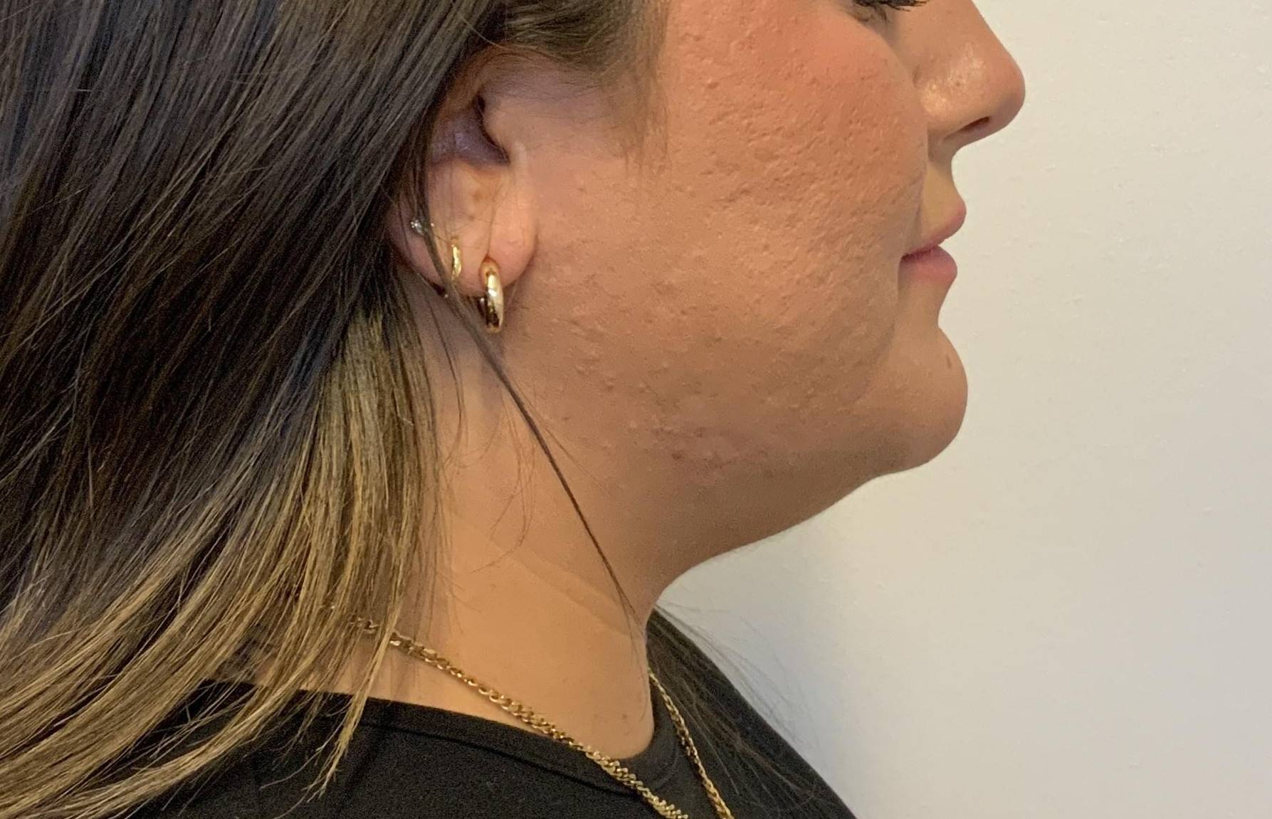 30-year-old female, submental liposuction Before