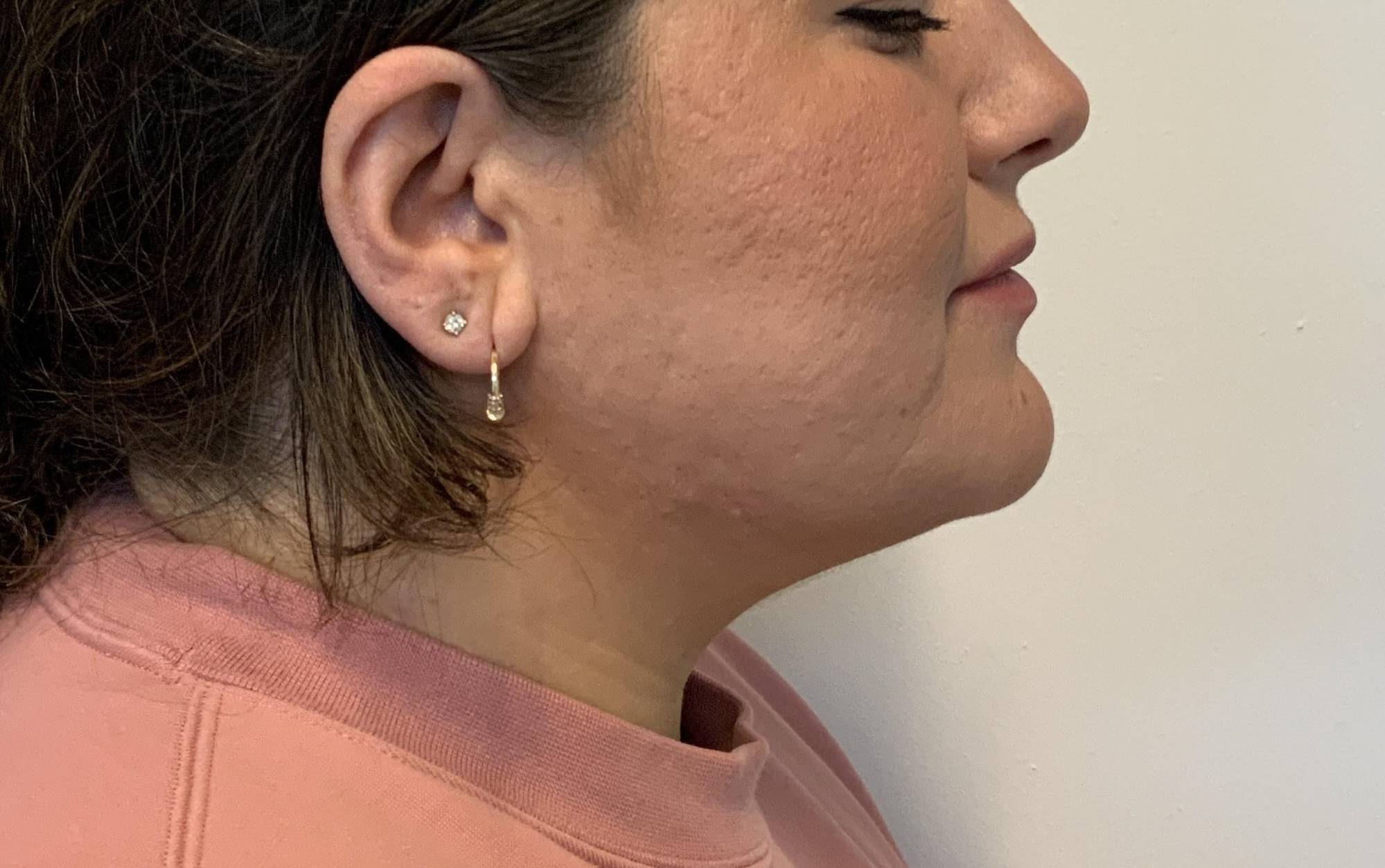 30-year-old female, submental liposuction After