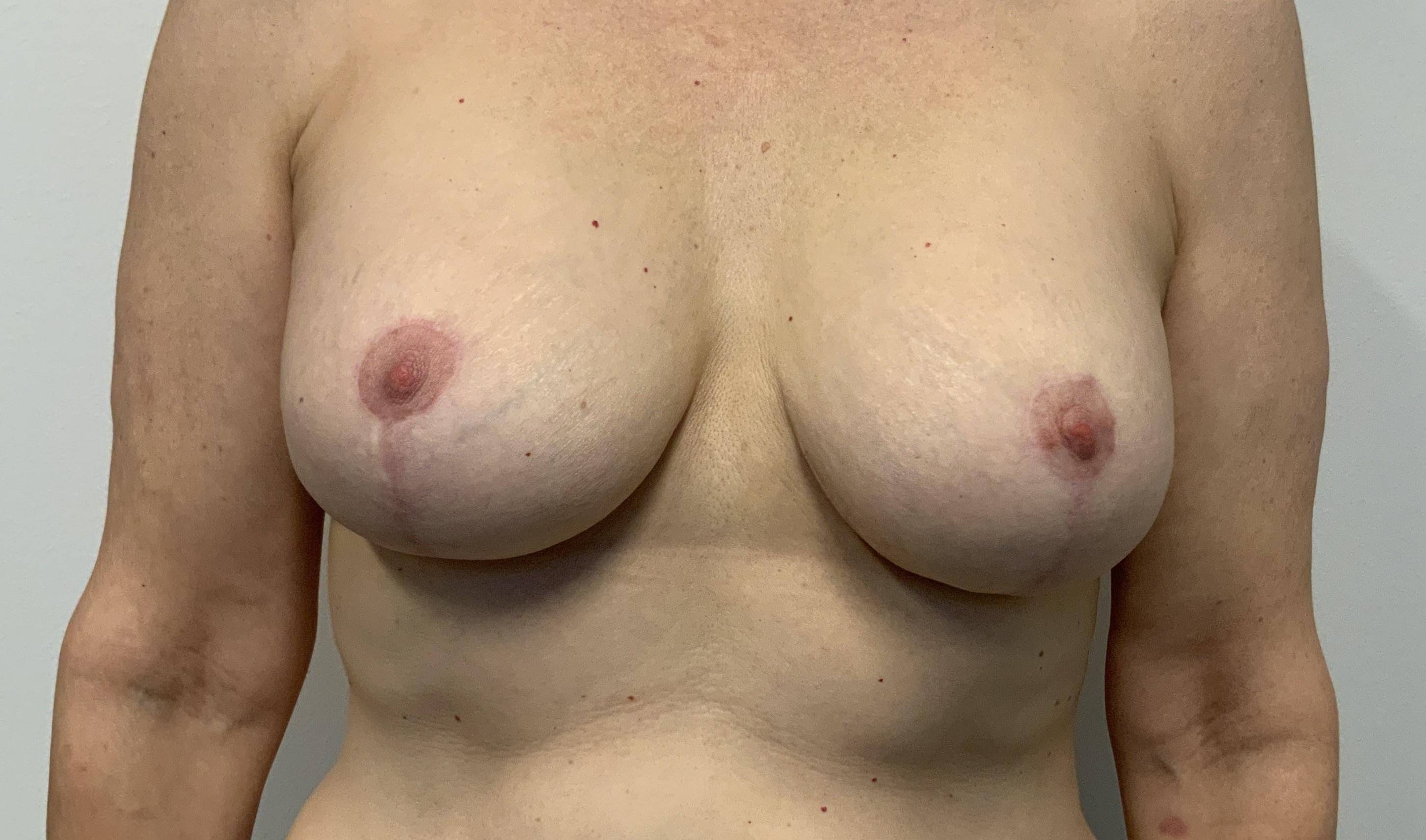 54-year-old female, breast implant exchange After