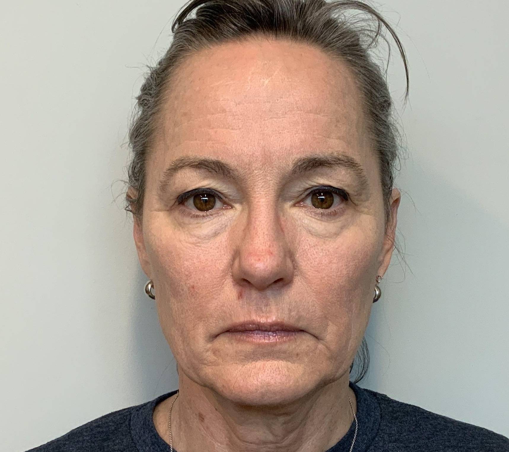 62-year-old female, facelift, upper & lower blepharoplasty, lateral temporalplasty Before