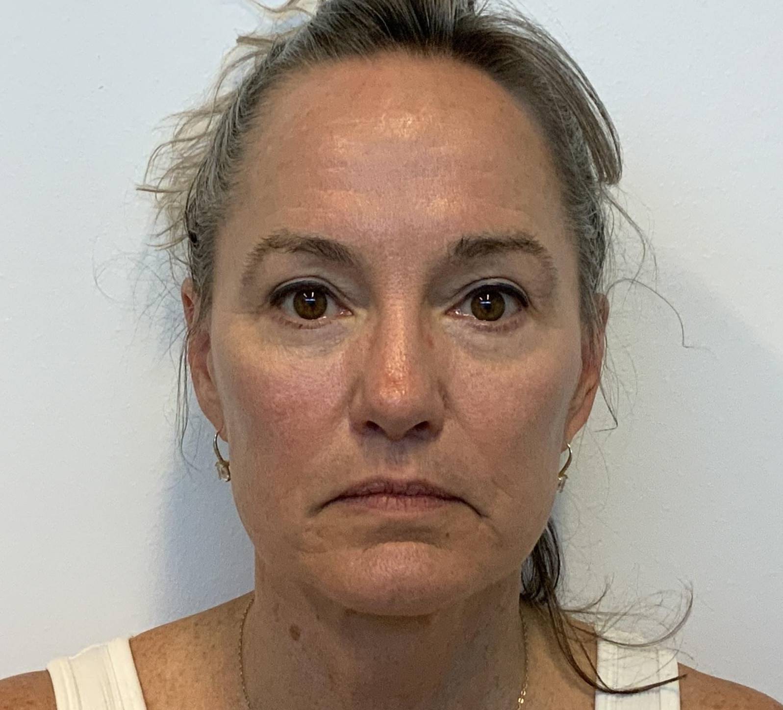 62-year-old female, facelift, upper & lower blepharoplasty, lateral temporalplasty After