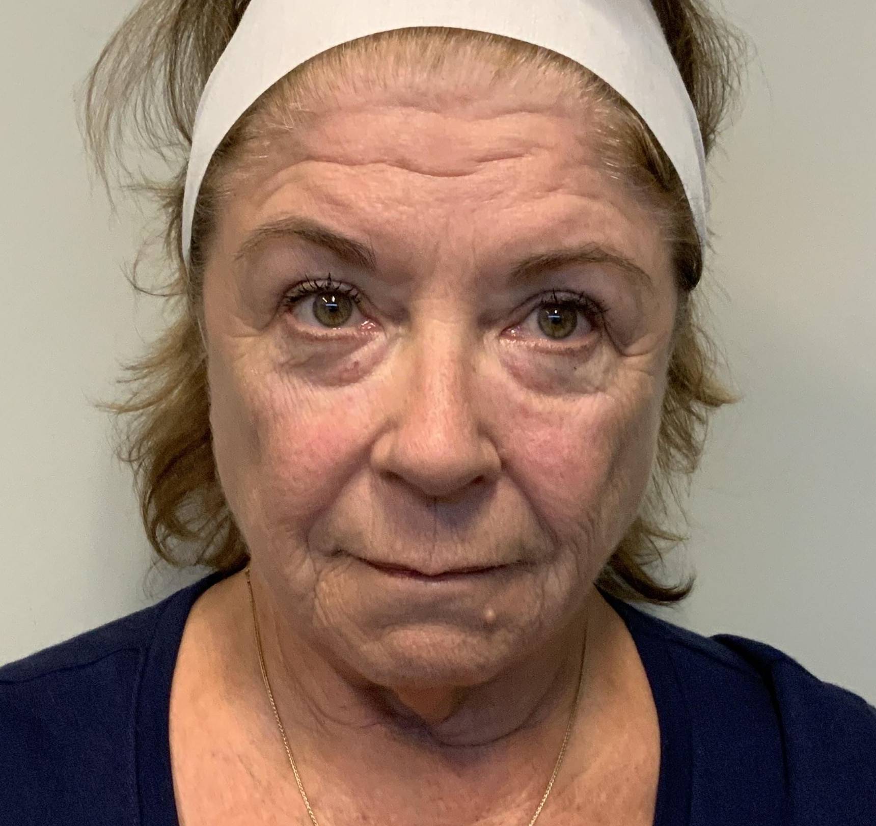 71-year-old female, facelift, lip lift, lower blepharoplasty Before