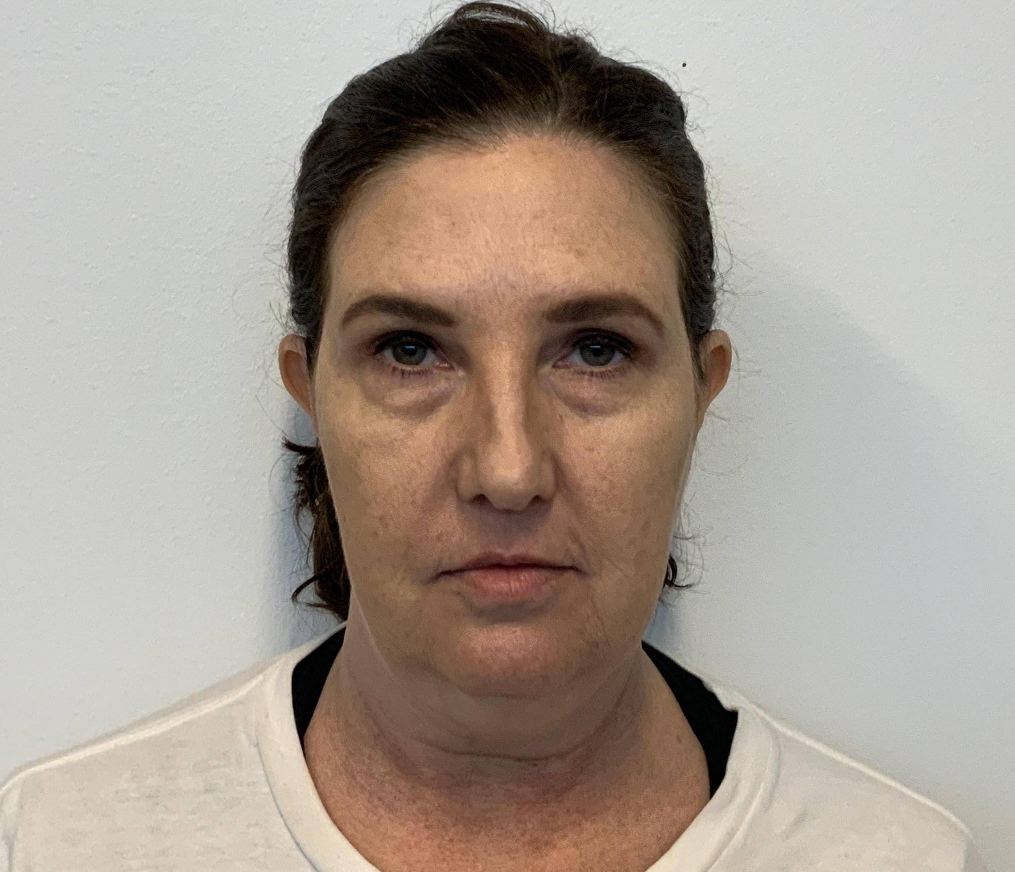 54-year-old female, facelift, lower blepharoplasty, buccal fat excision, neck lift Before