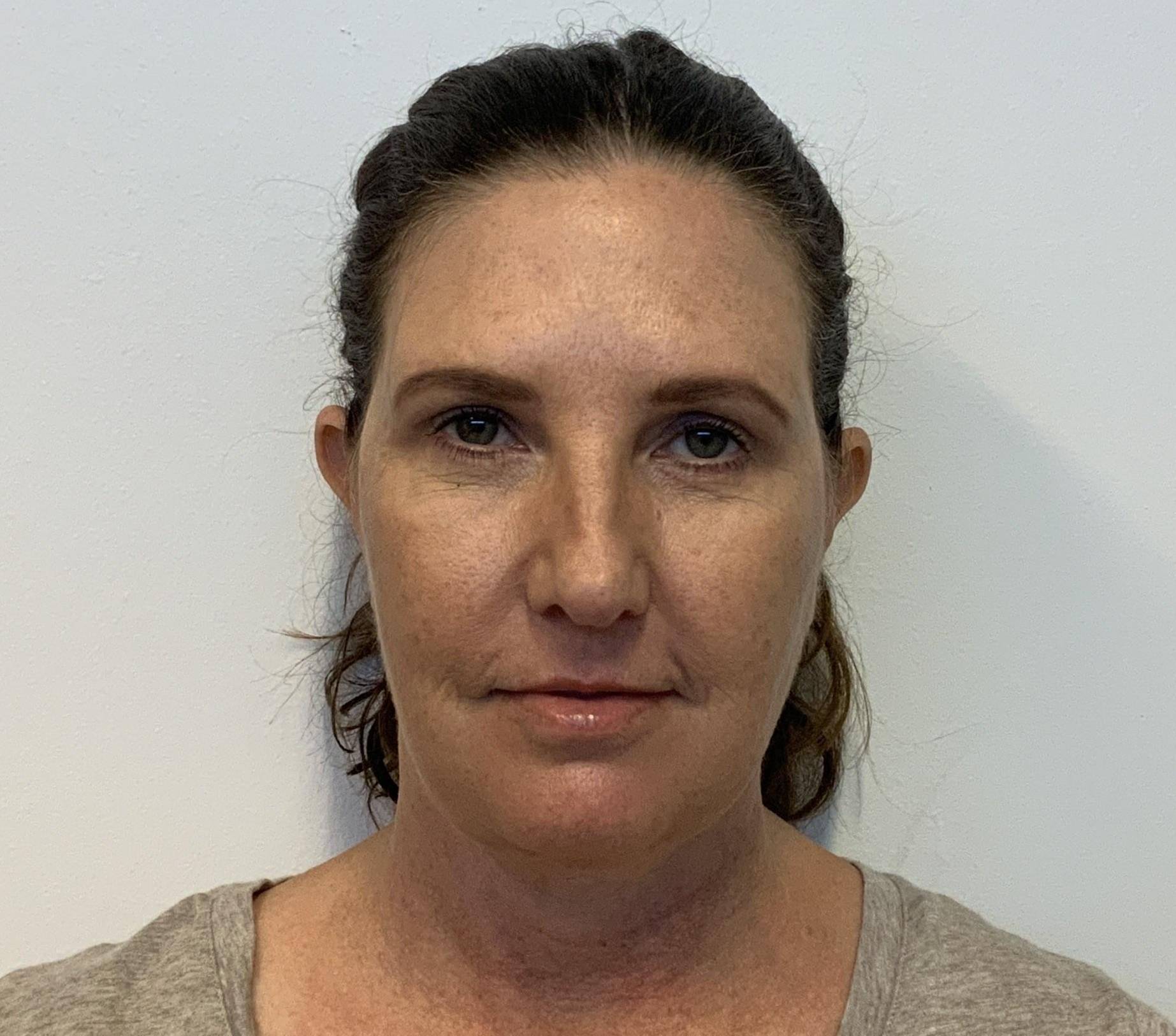 54-year-old female, facelift, lower blepharoplasty, buccal fat excision, neck lift After