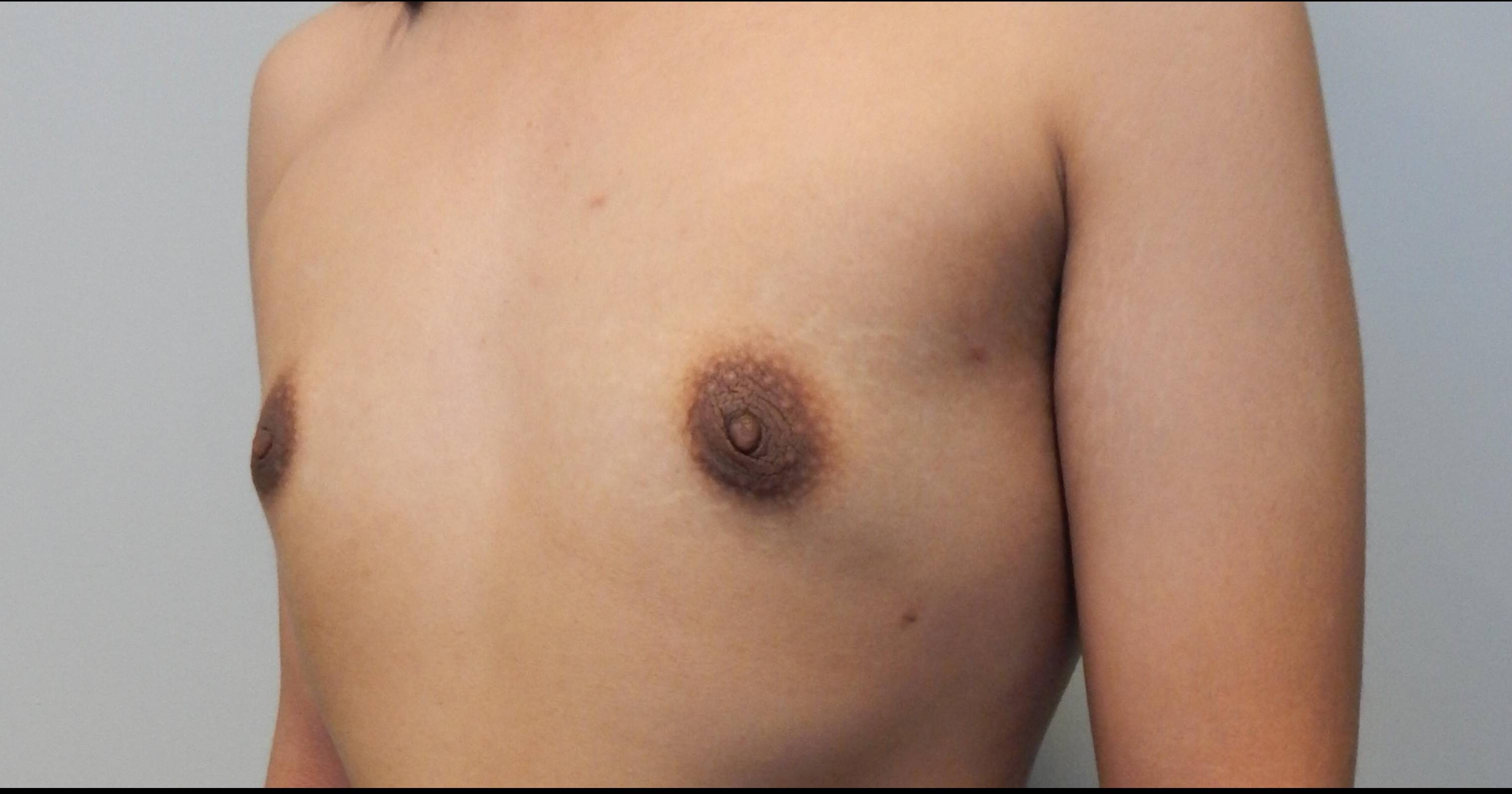 24-year-old male, gynecomastia After