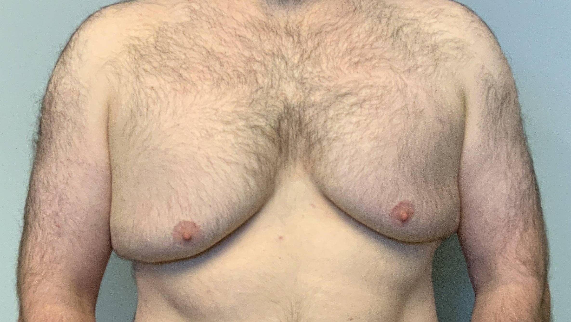 35-year-old male, gynecomastia with free nipple graft, liposuction to flanks and lateral chest Before