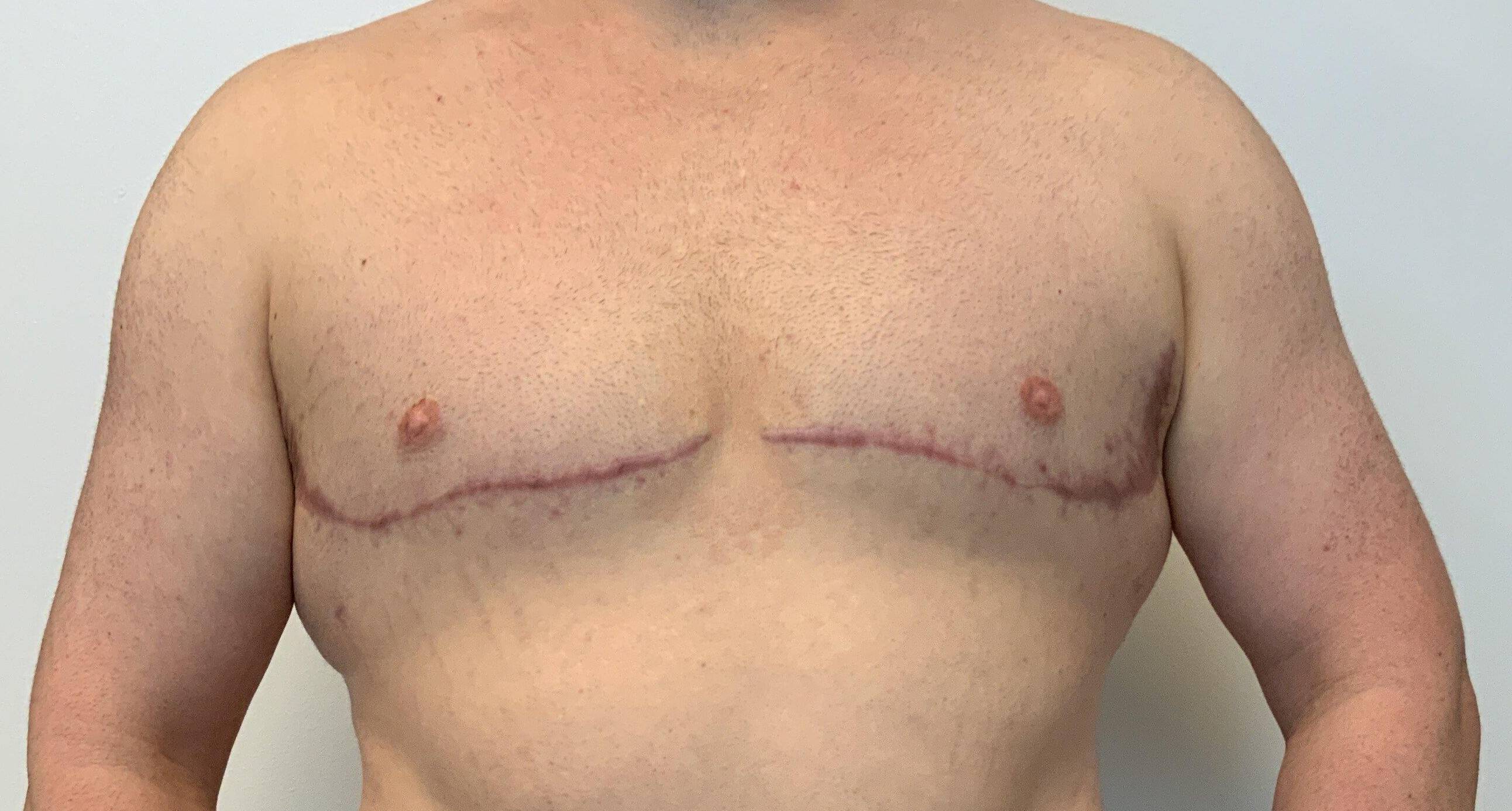 35-year-old male, gynecomastia with free nipple graft, liposuction to flanks and lateral chest After