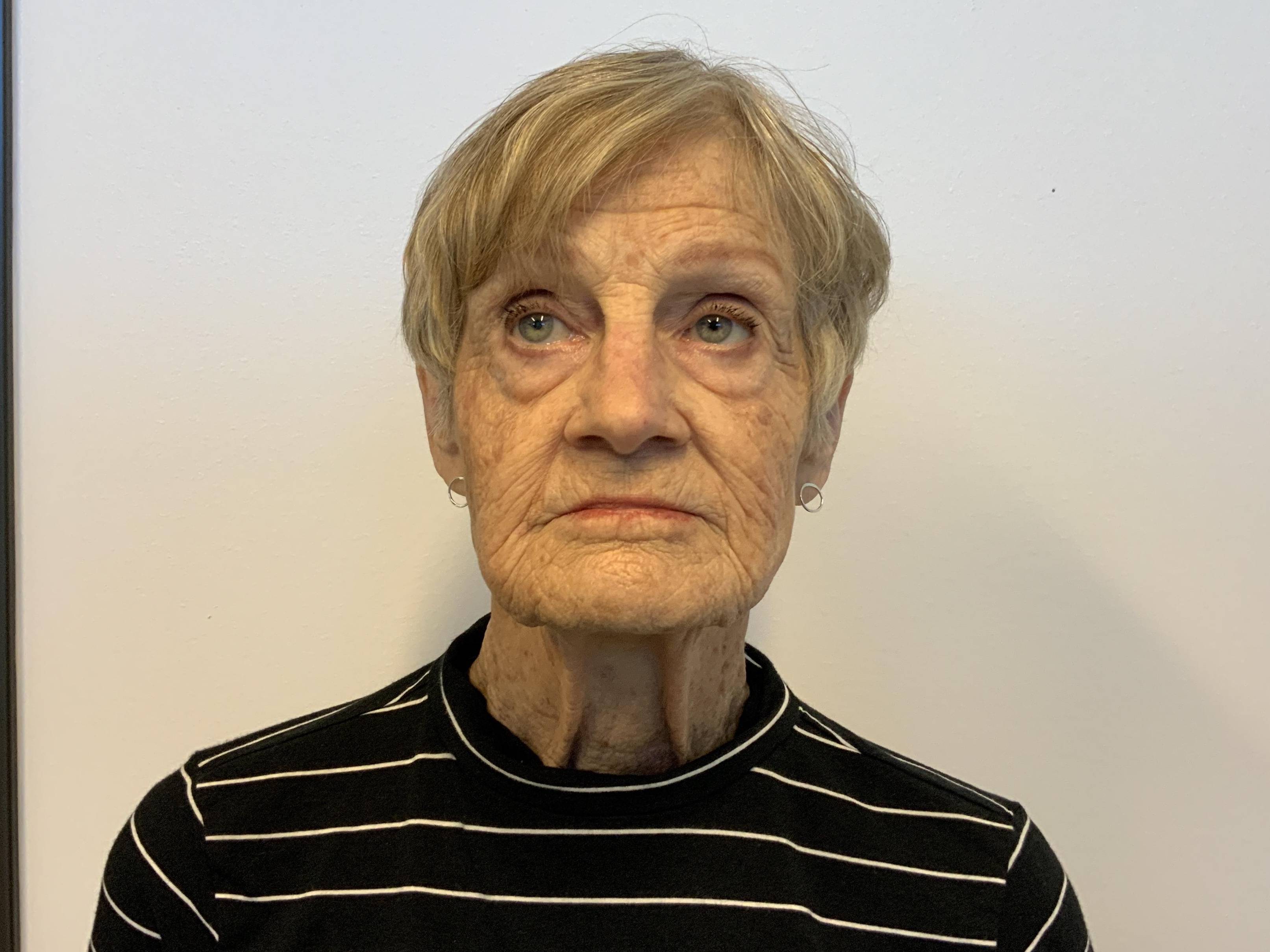 Graceful Rejuvenation at 75: Facelift, Neck Lift, Lower Blepharoplasty, and Fat Grafting Before