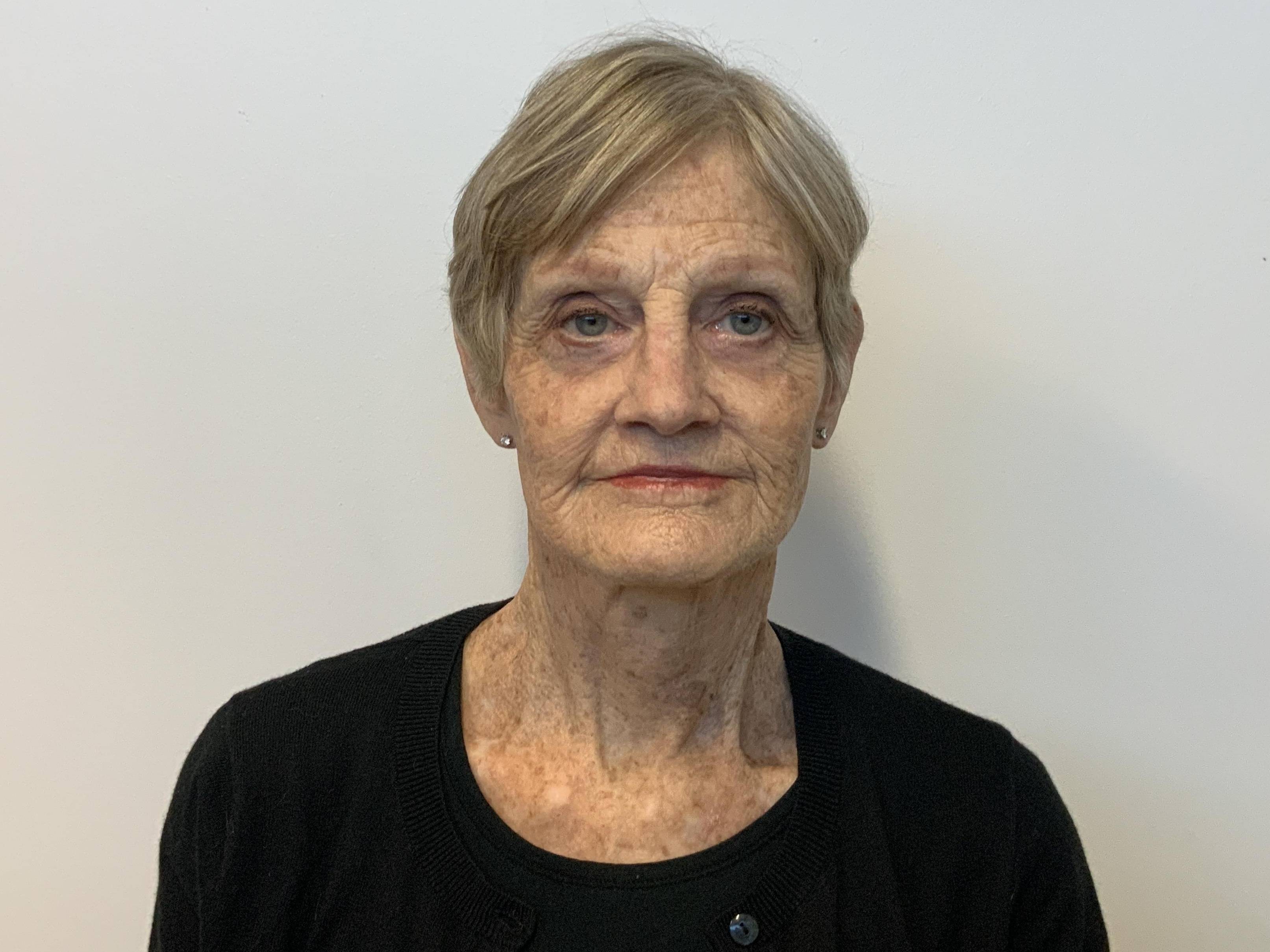 Graceful Rejuvenation at 75: Facelift, Neck Lift, Lower Blepharoplasty, and Fat Grafting After