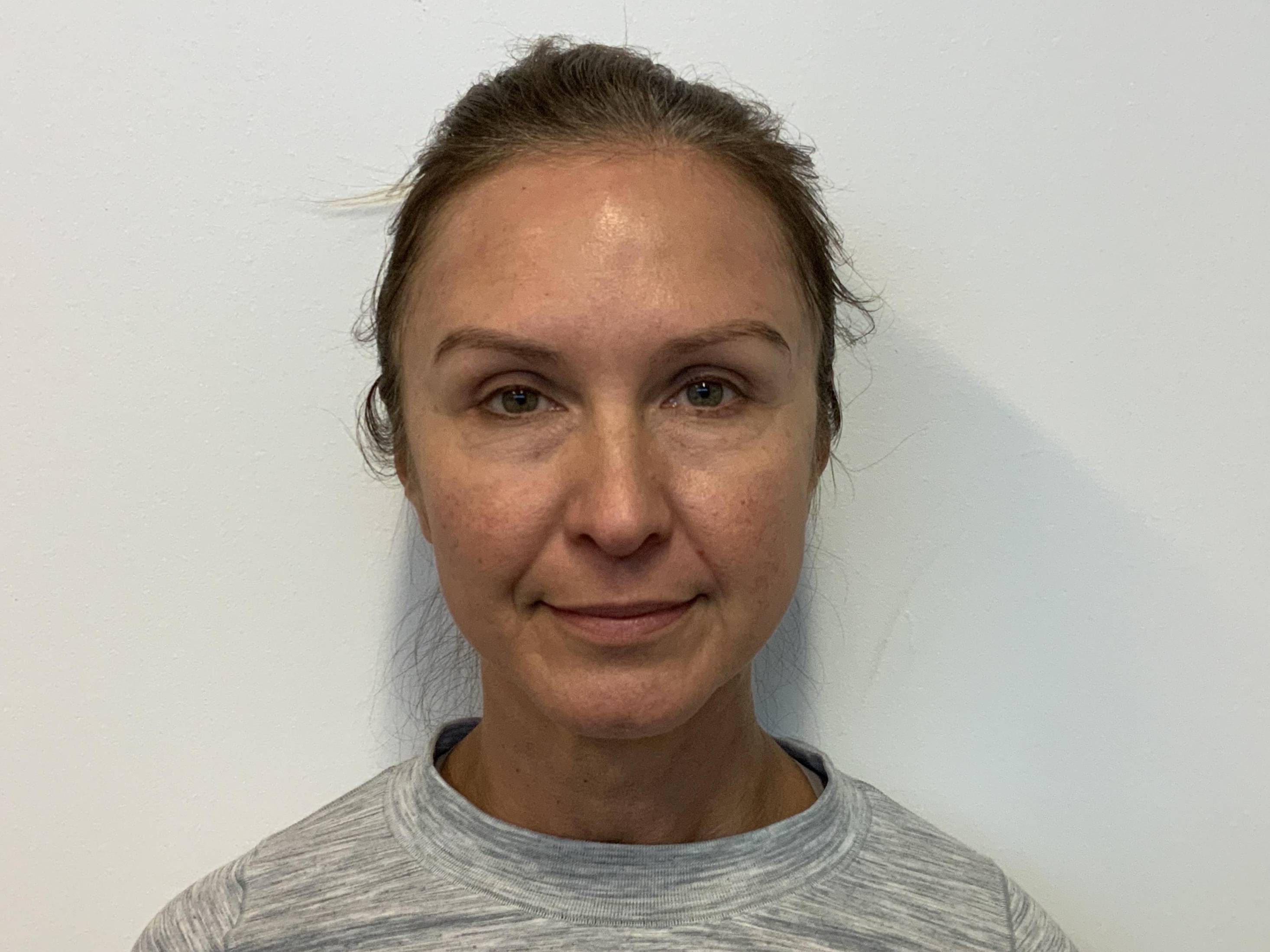Bright-Eyed and Refreshed: Lower Blepharoplasty at 51 Before