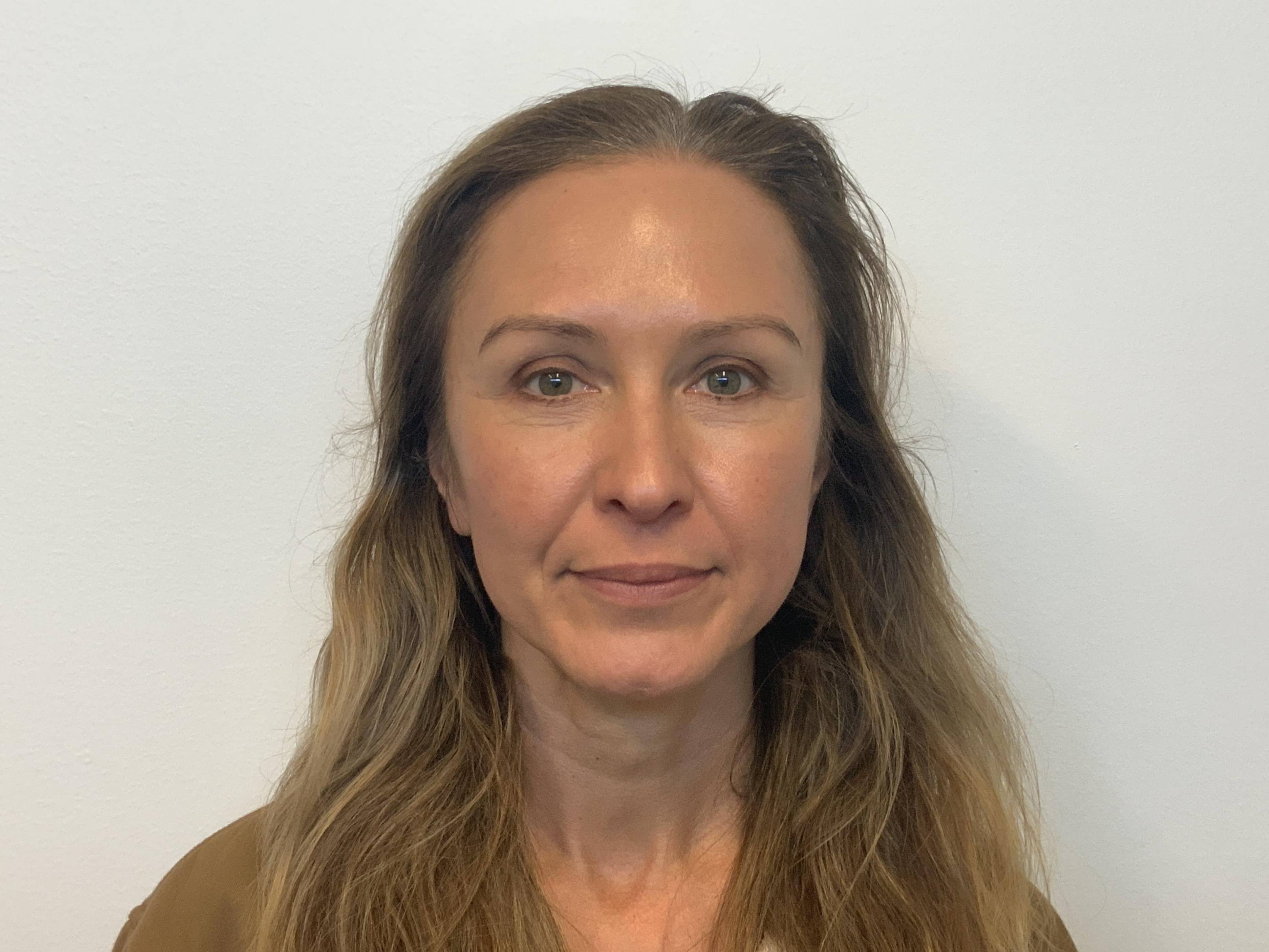 Bright-Eyed and Refreshed: Lower Blepharoplasty at 51 After