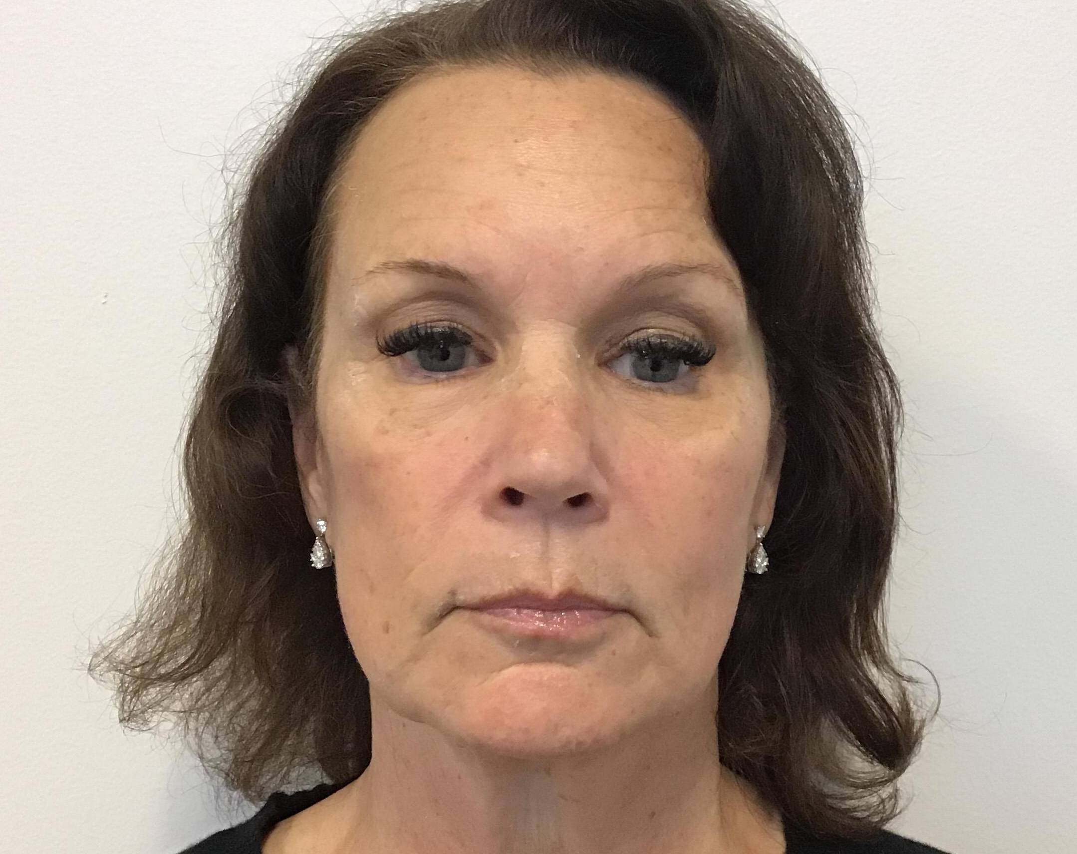 Radiant Renewal at 61: Facelift, Upper and Lower Blepharoplasty, and Lip Lift Before
