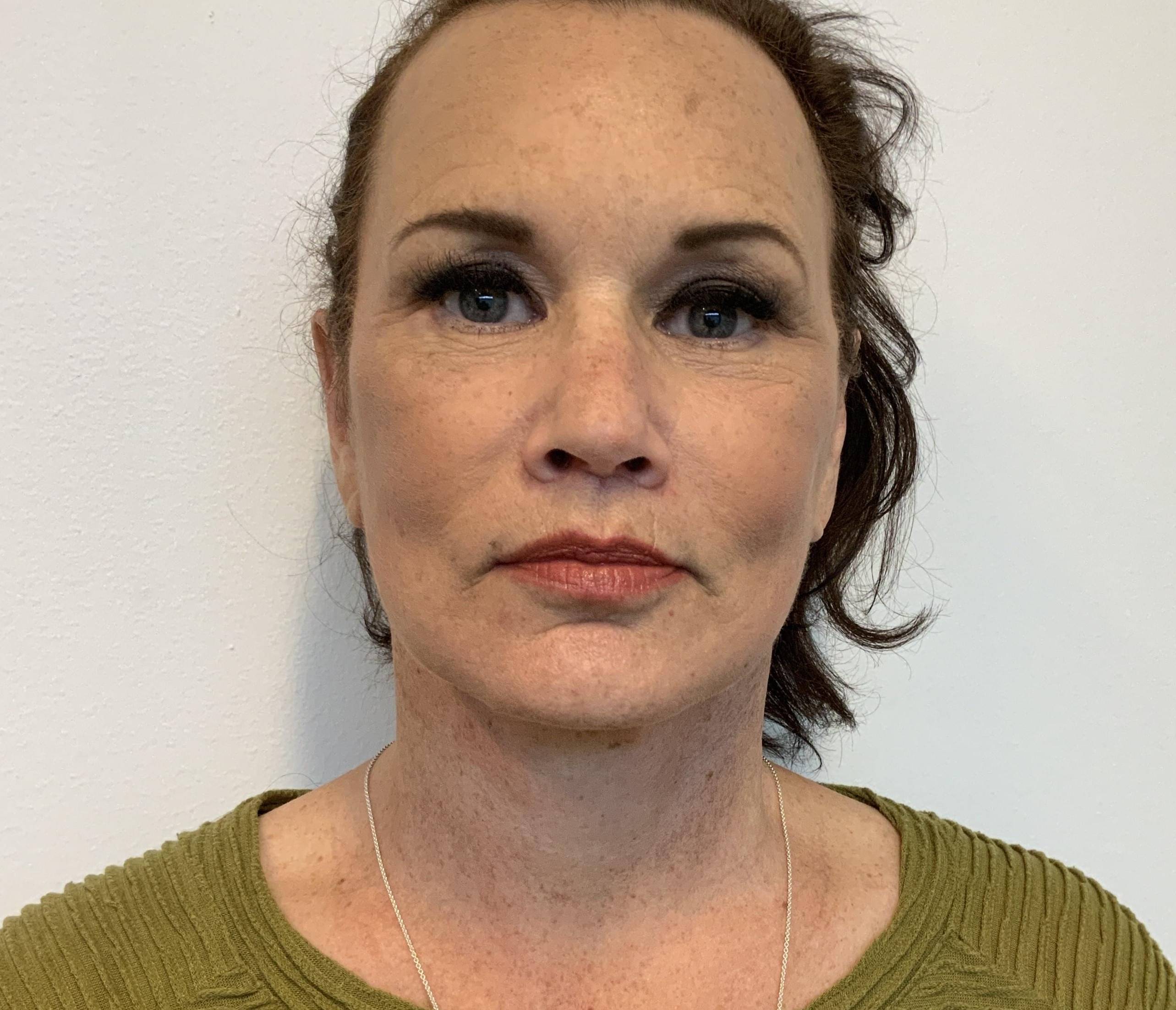 Radiant Renewal at 61: Facelift, Upper and Lower Blepharoplasty, and Lip Lift After