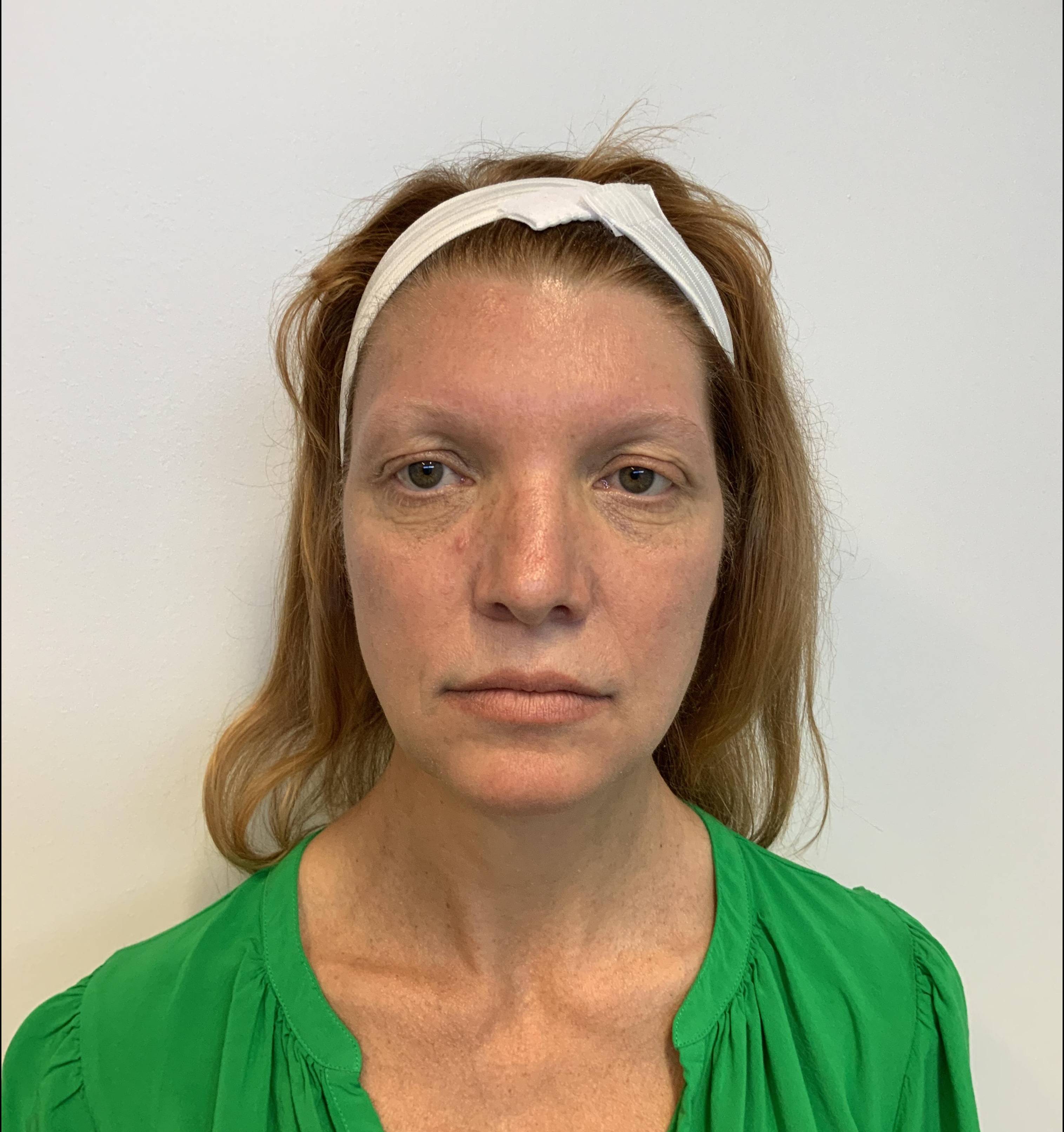 Elegant Rejuvenation at 53: Facelift, Neck Lift, Upper and Lower Blepharoplasty, and Brow Lift Before