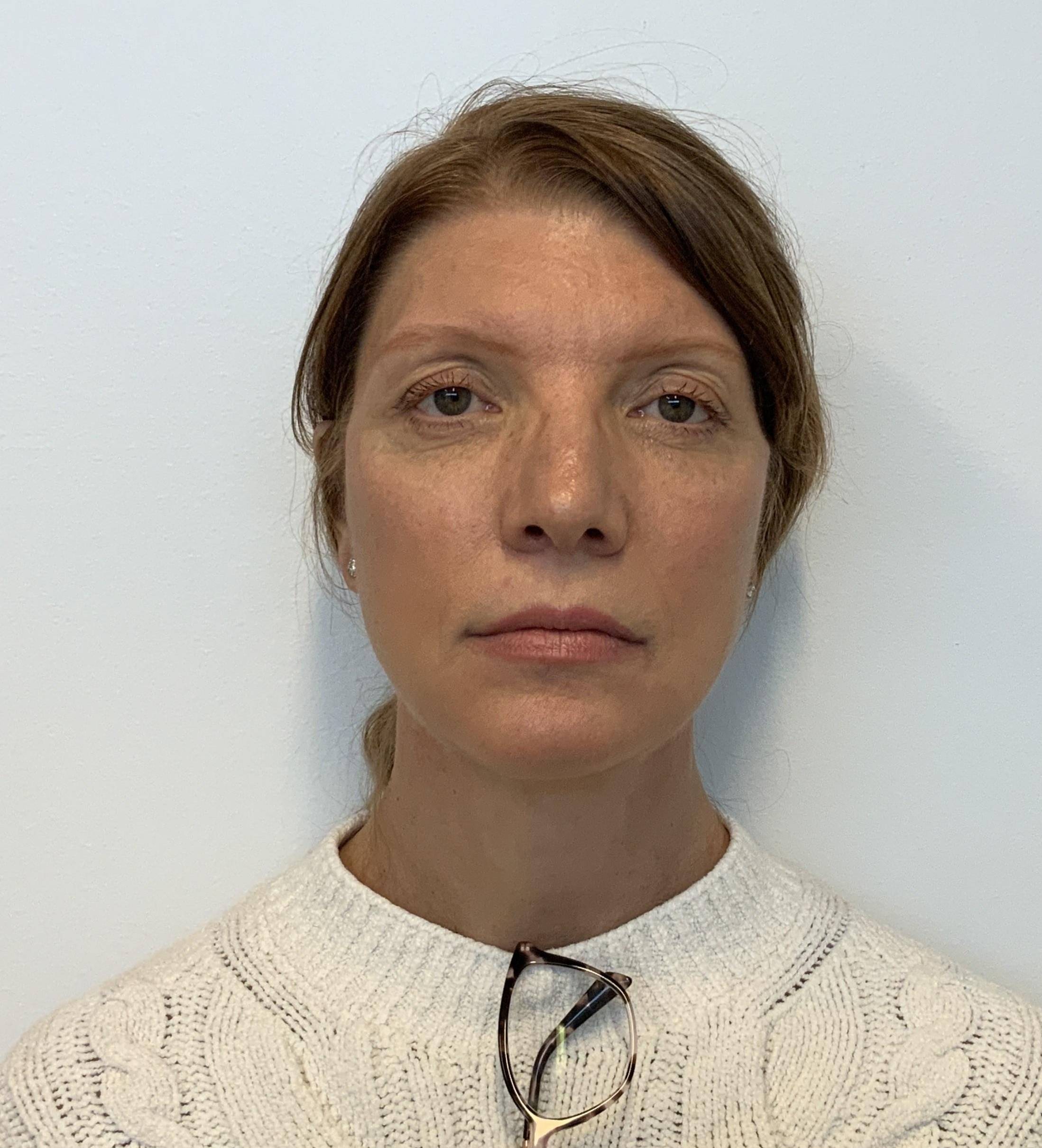 Elegant Rejuvenation at 53: Facelift, Neck Lift, Upper and Lower Blepharoplasty, and Brow Lift After