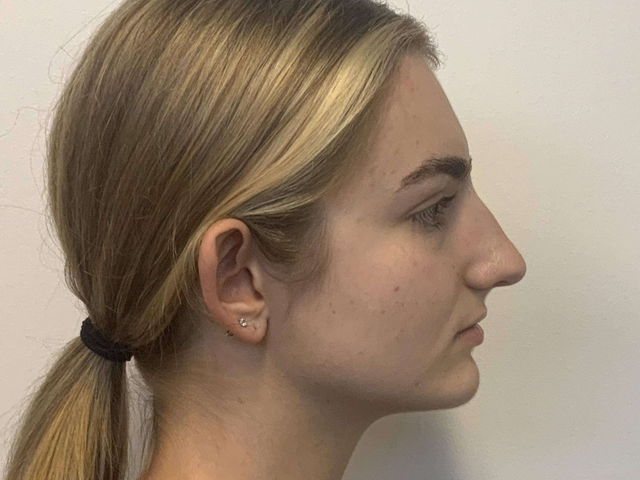 Natural Harmony at 19: Rhinoplasty Before