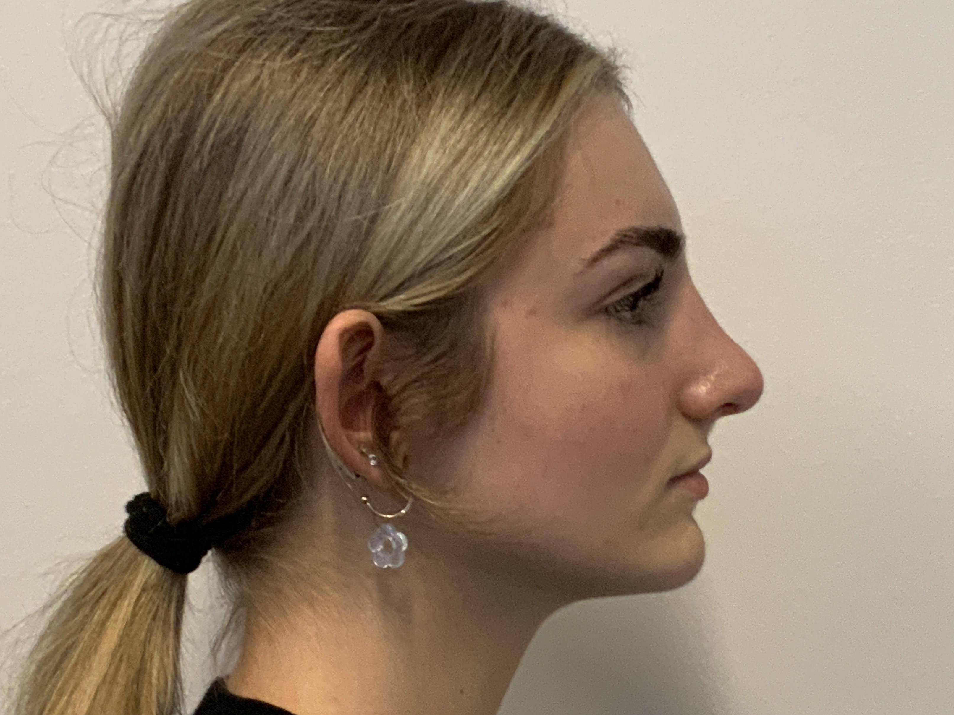 Natural Harmony at 19: Rhinoplasty After