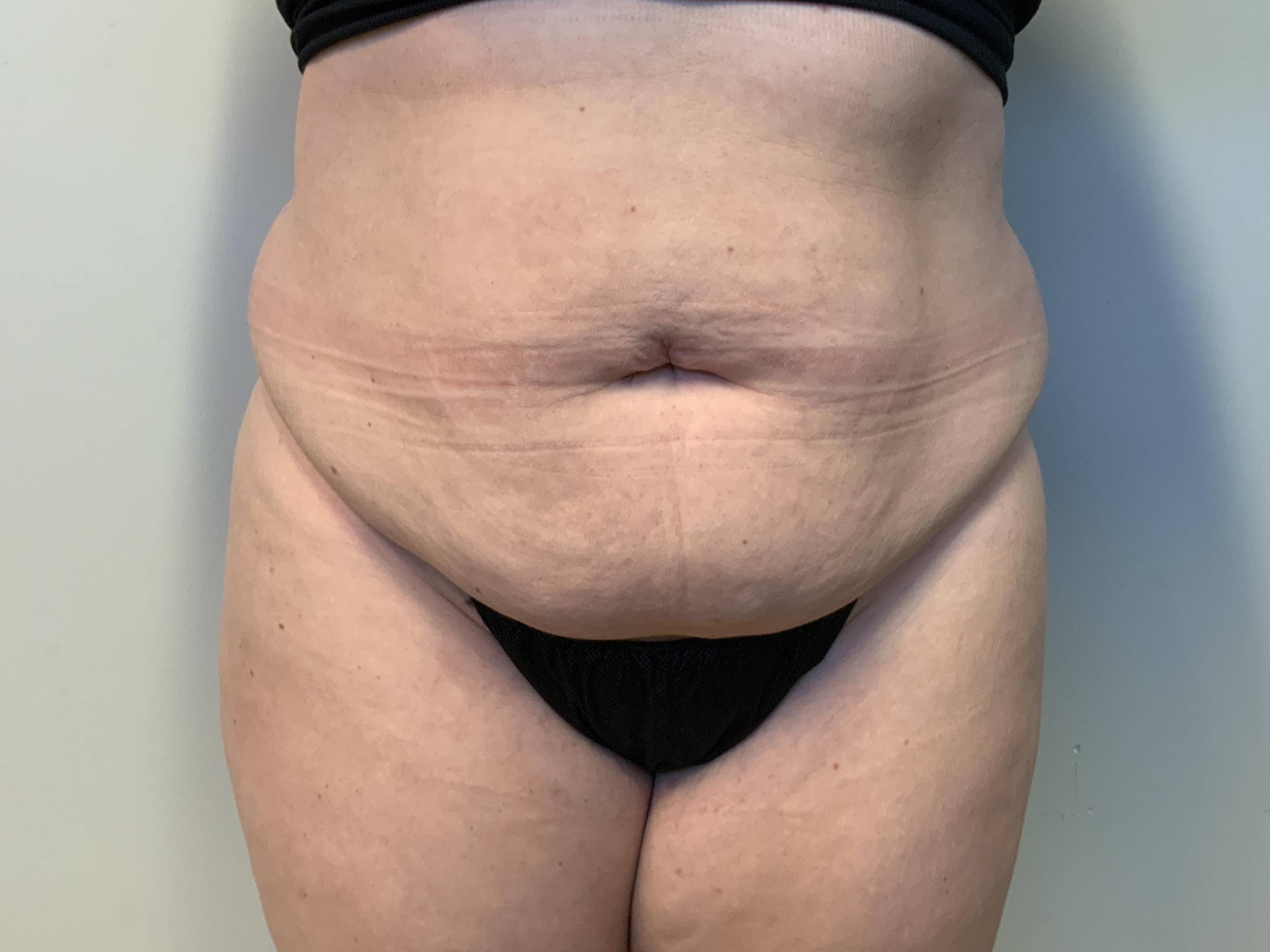 Post-C-Section Confidence at 30: Extended Abdominoplasty and Flank Liposuction Before