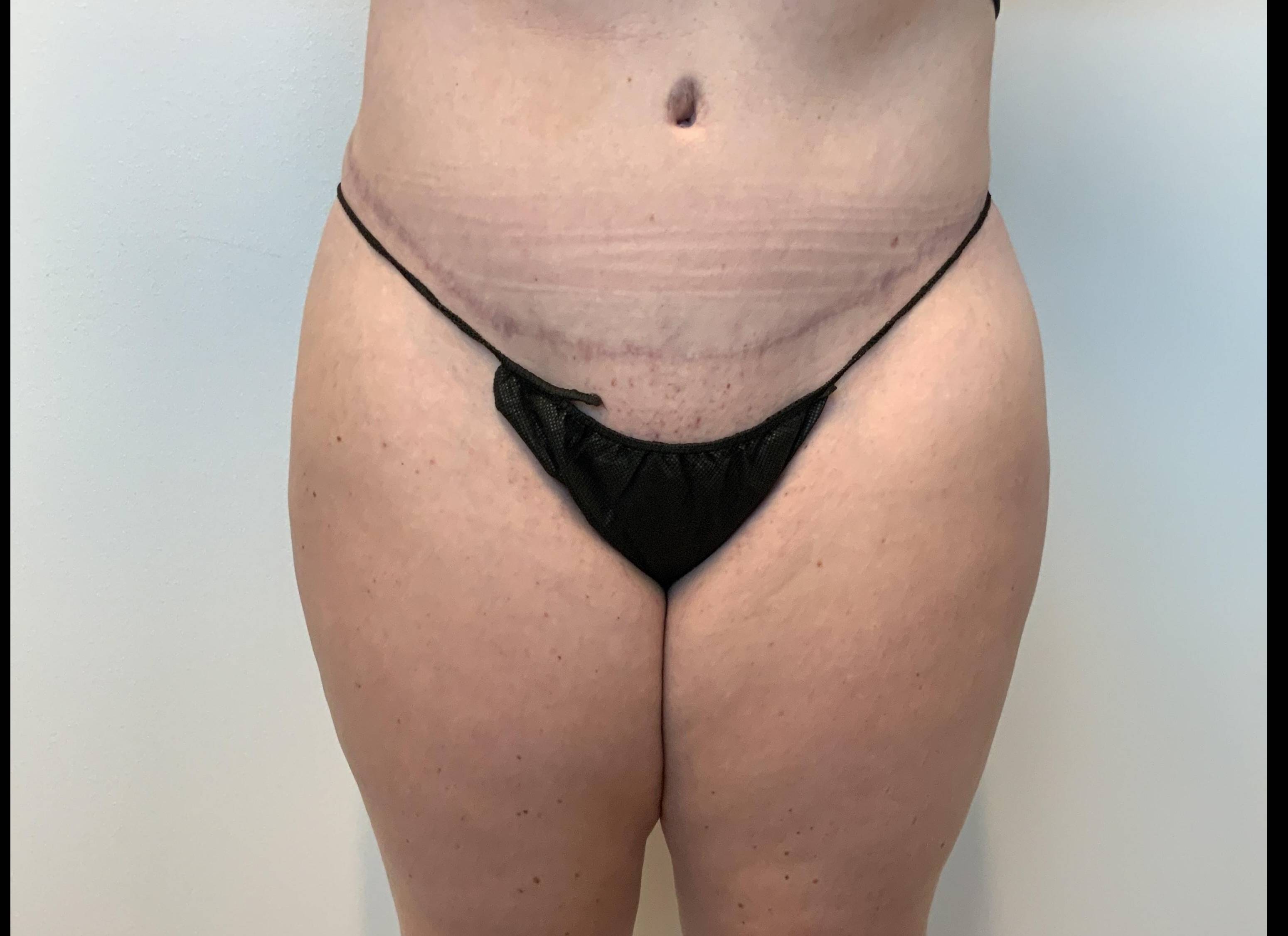 Post-C-Section Confidence at 30: Extended Abdominoplasty and Flank Liposuction After