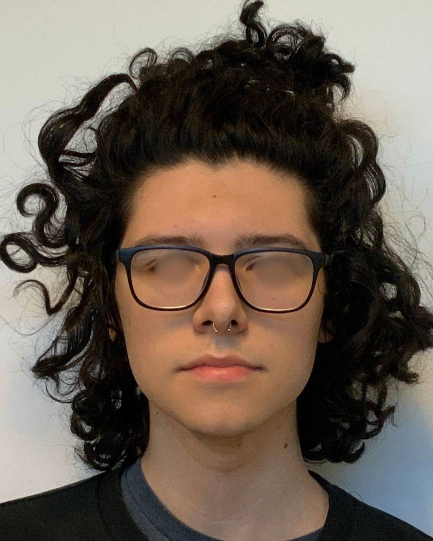 Rhinoplasty + Submental Liposuction After