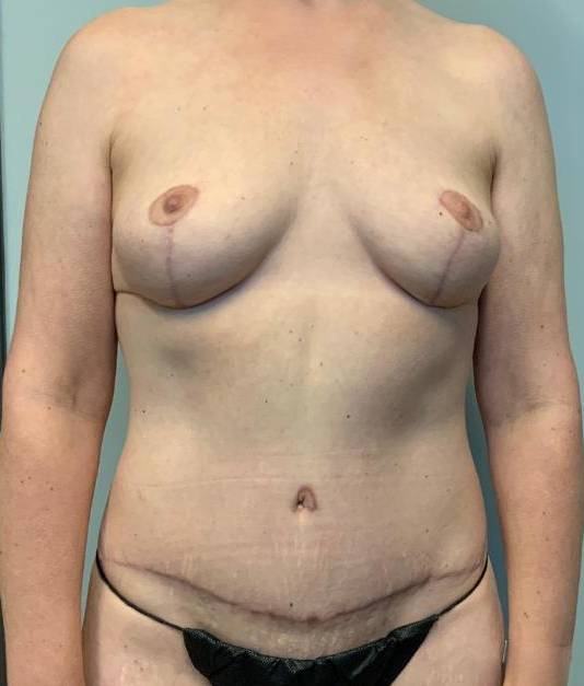 Abdominoplasty and Mastopexy After Abdominoplasty and Mastopexy After