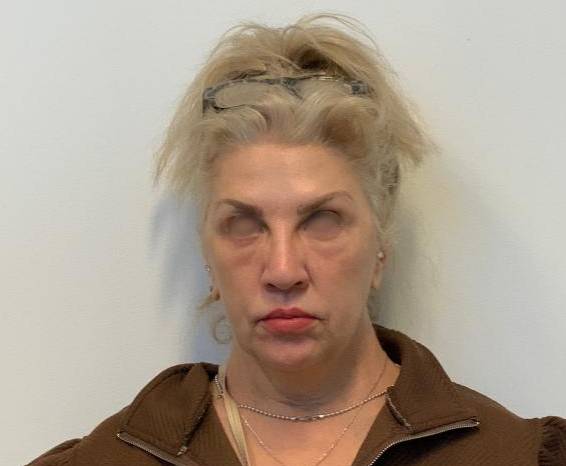 Facelift with bilateral lower blepharoplasty Before