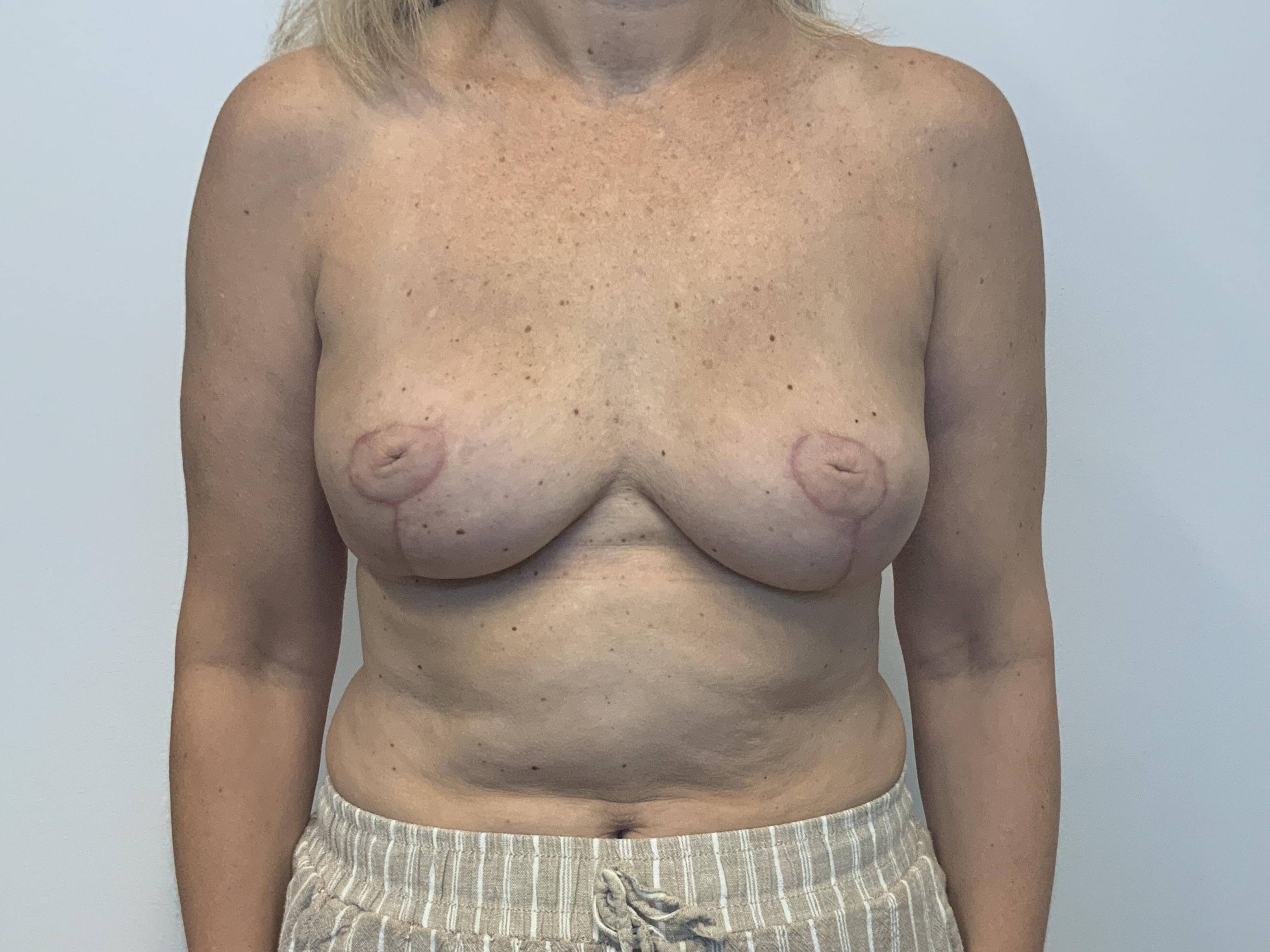Breast implant removal After