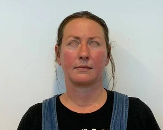 Facelift with upper blepharoplasty After