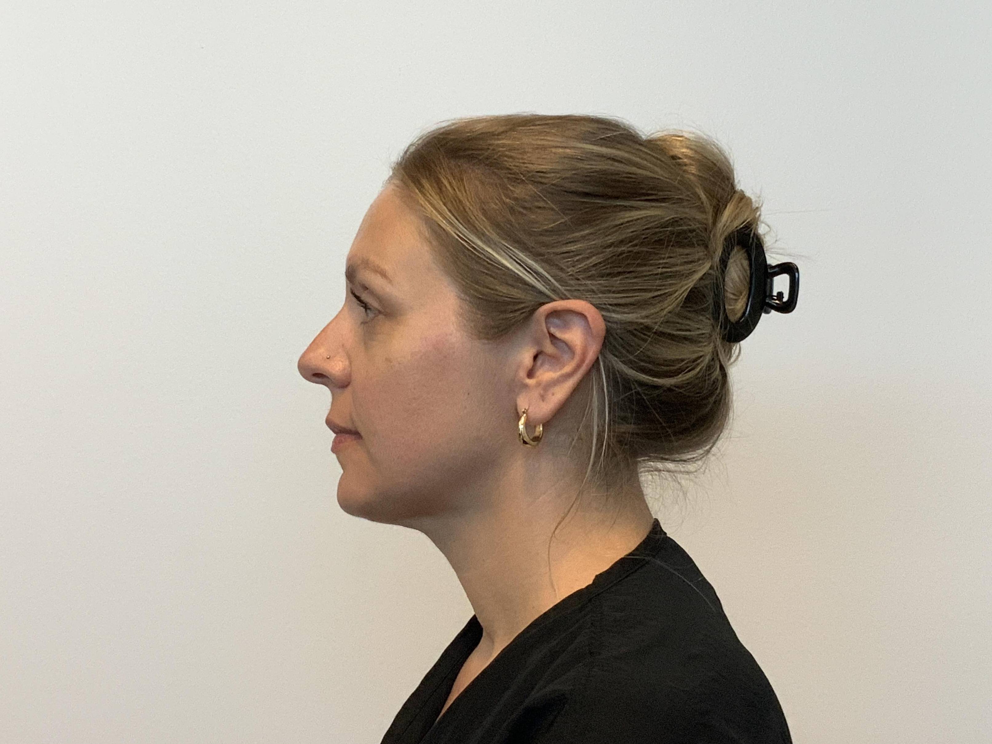 Submental Liposuction After